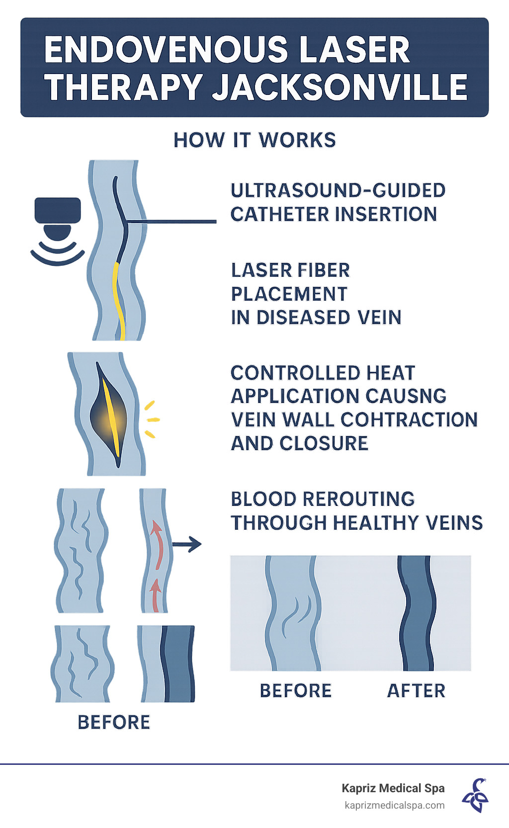 Diagram showing how endovenous laser therapy works: ultrasound-guided catheter insertion, laser fiber placement in the diseased vein, controlled heat application causing vein wall contraction and closure, and blood rerouting through healthy veins with before and after comparison images - Endovenous laser therapy Jacksonville infographic