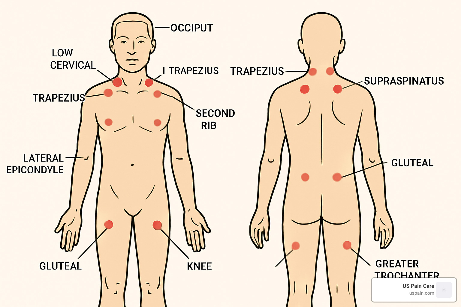 body diagram showing common fibromyalgia tender points - aches and pains