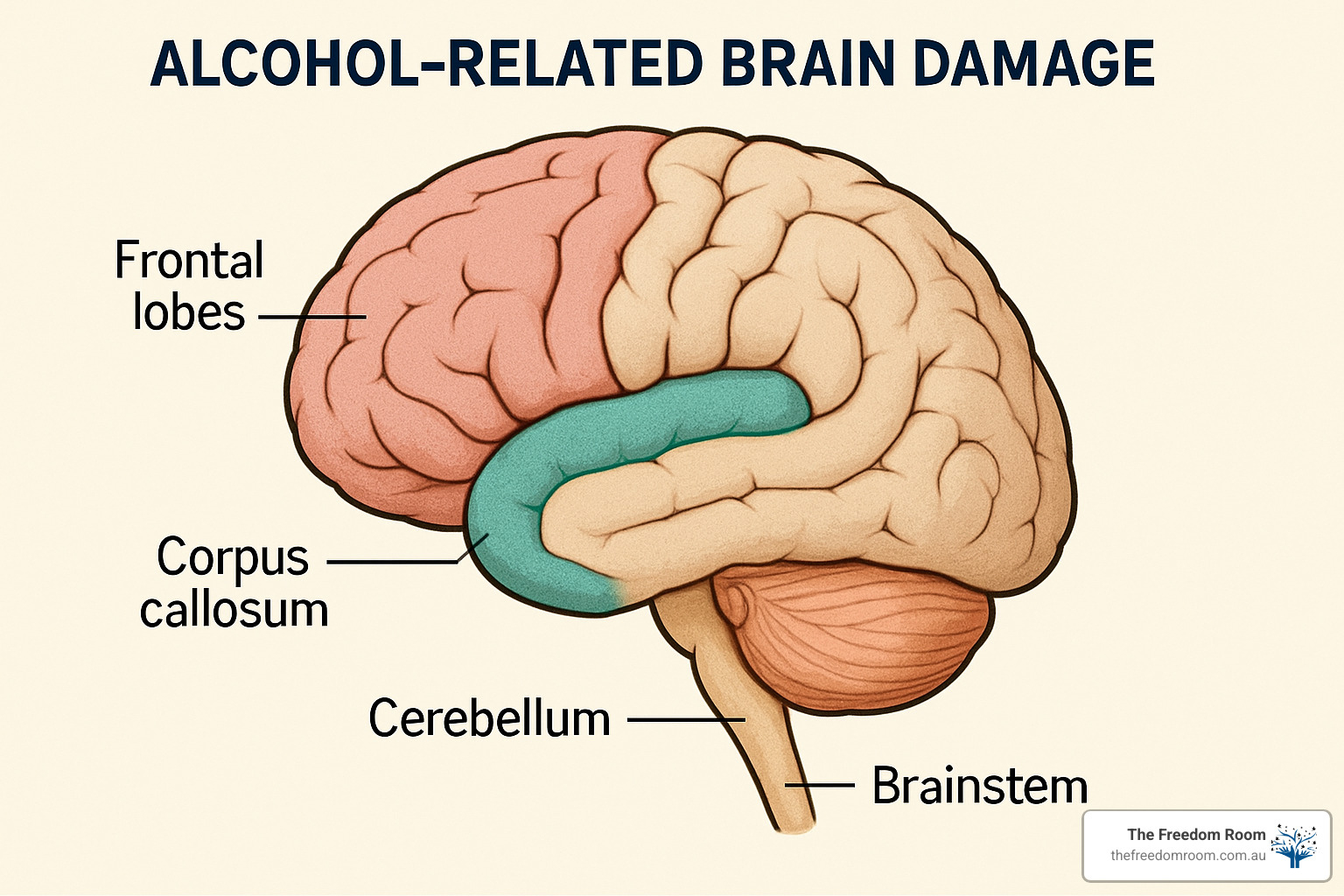 Brain regions affected by Alcohol-Related Brain Damage - long term effects of alcohol on the brain