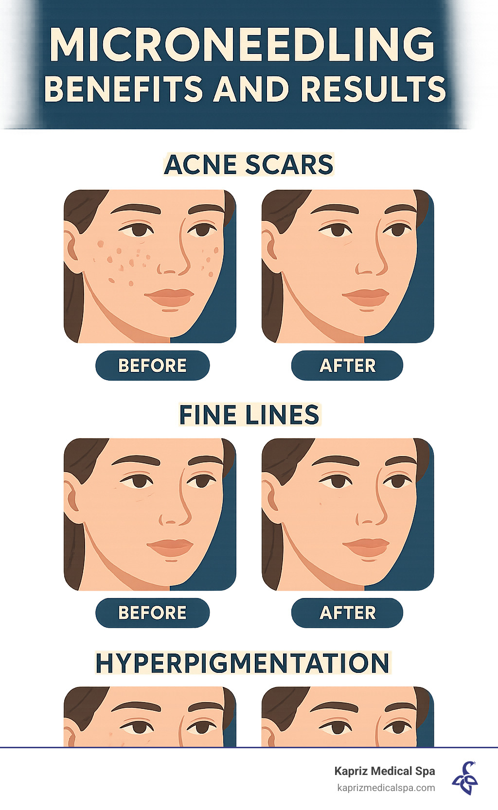Microneedling benefits and results showing before and after changes for common skin concerns including acne scars, fine lines, and hyperpigmentation - microneedling jacksonville beach fl infographic 