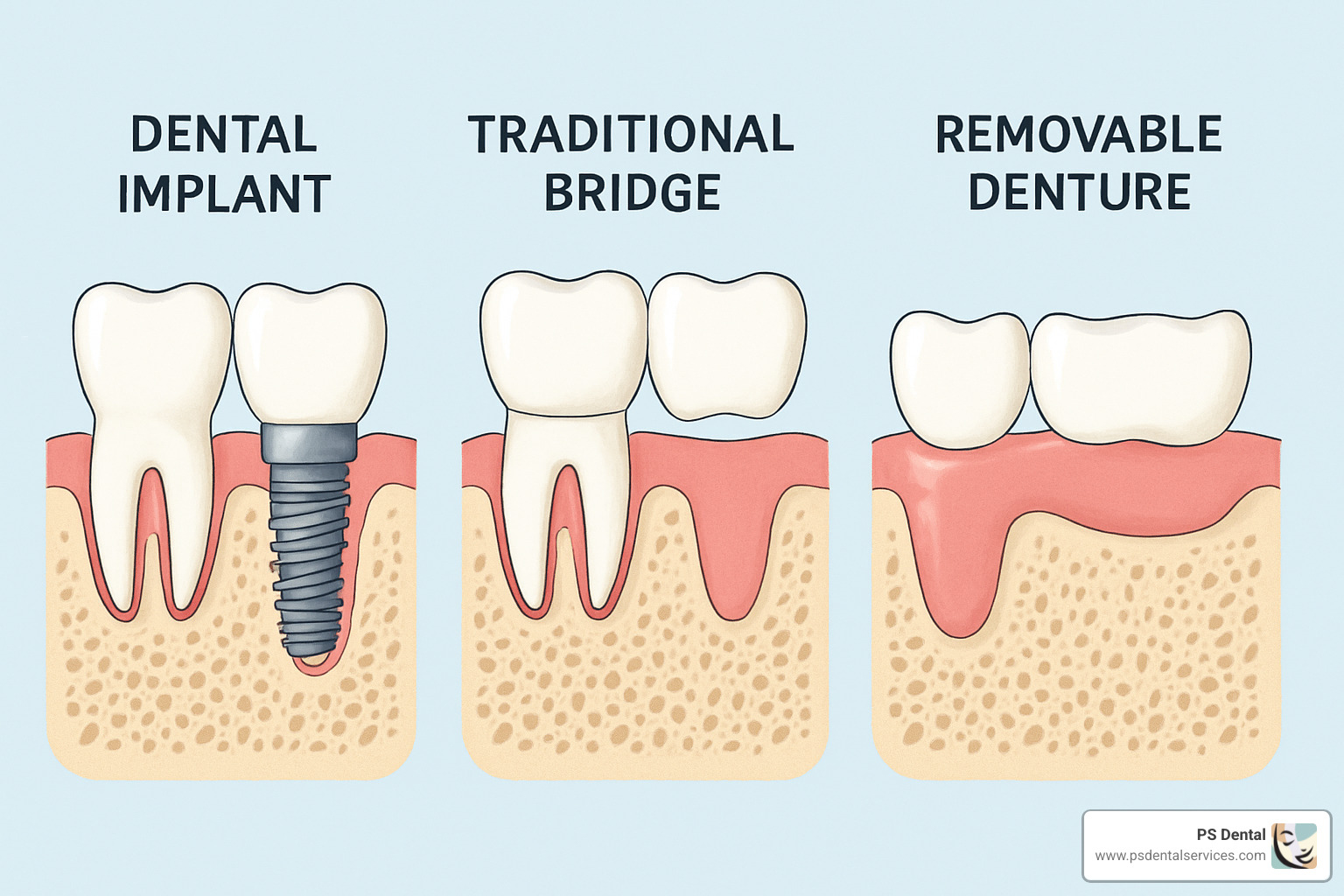 comparison of a dental implant next to a traditional bridge and removable denture showing the structural differences - Oregon dental implants