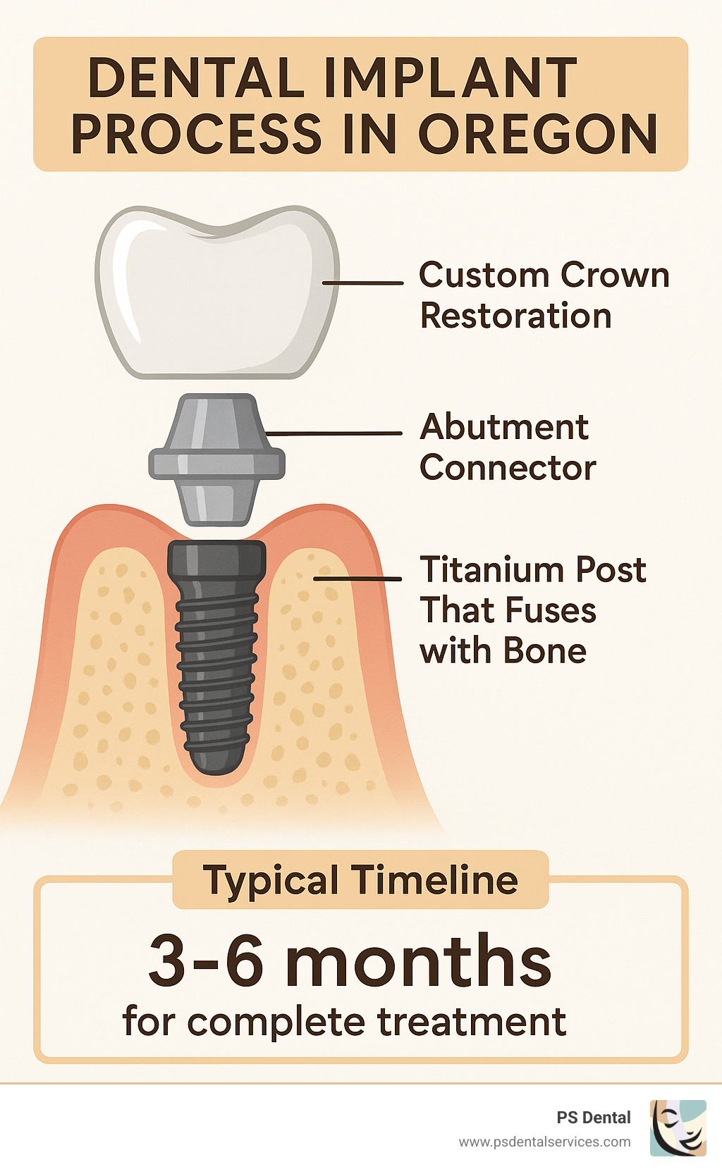 Dental Implant Process in Oregon showing the three components: titanium post that fuses with bone, abutment connector, and custom crown restoration, plus typical timeline of 3-6 months for complete treatment - Oregon dental implants infographic 