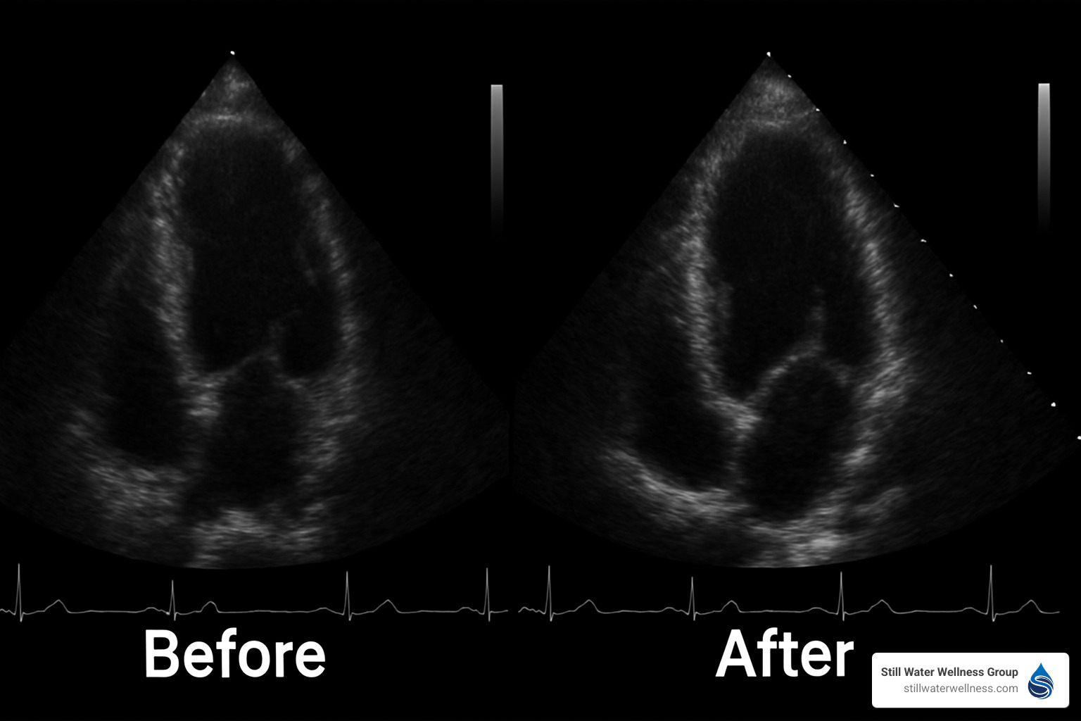 before and after echocardiogram showing heart function improvement - how does drug addiction affect the circulatory system