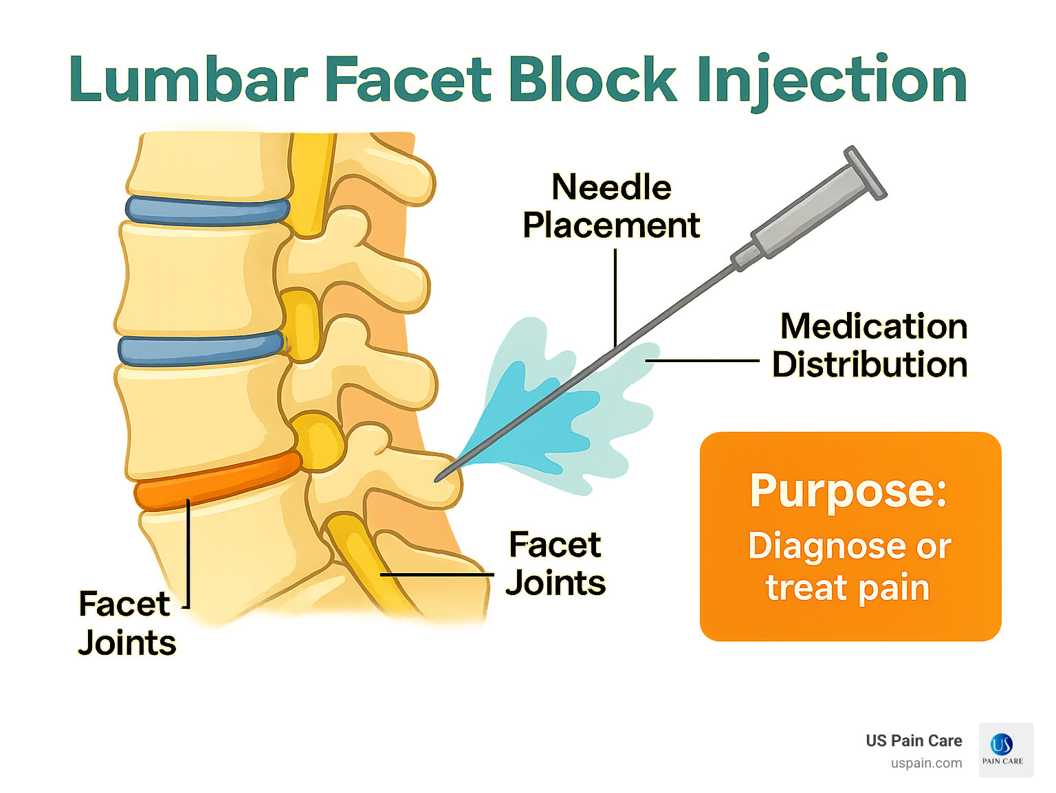 Diagram showing lumbar facet joints, needle placement, and medication distribution during a facet block injection - lumbar facet block injection infographic 