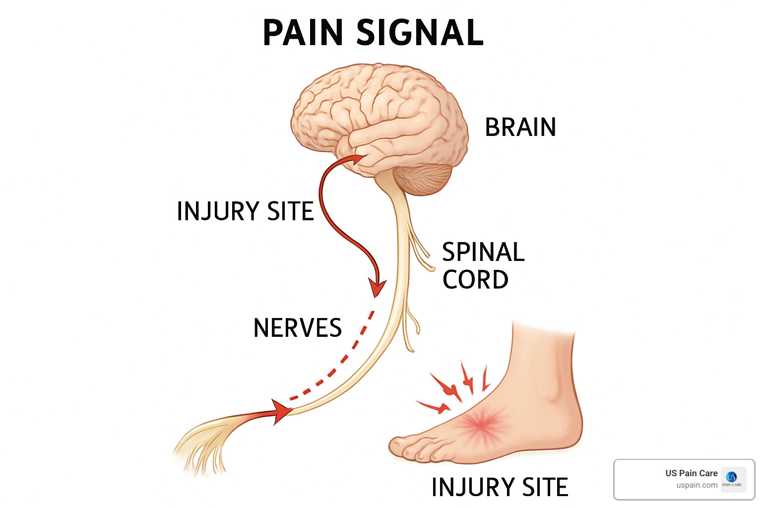 Neural pathways showing how pain signals travel from injury site through spinal cord to brain - chronic pain management