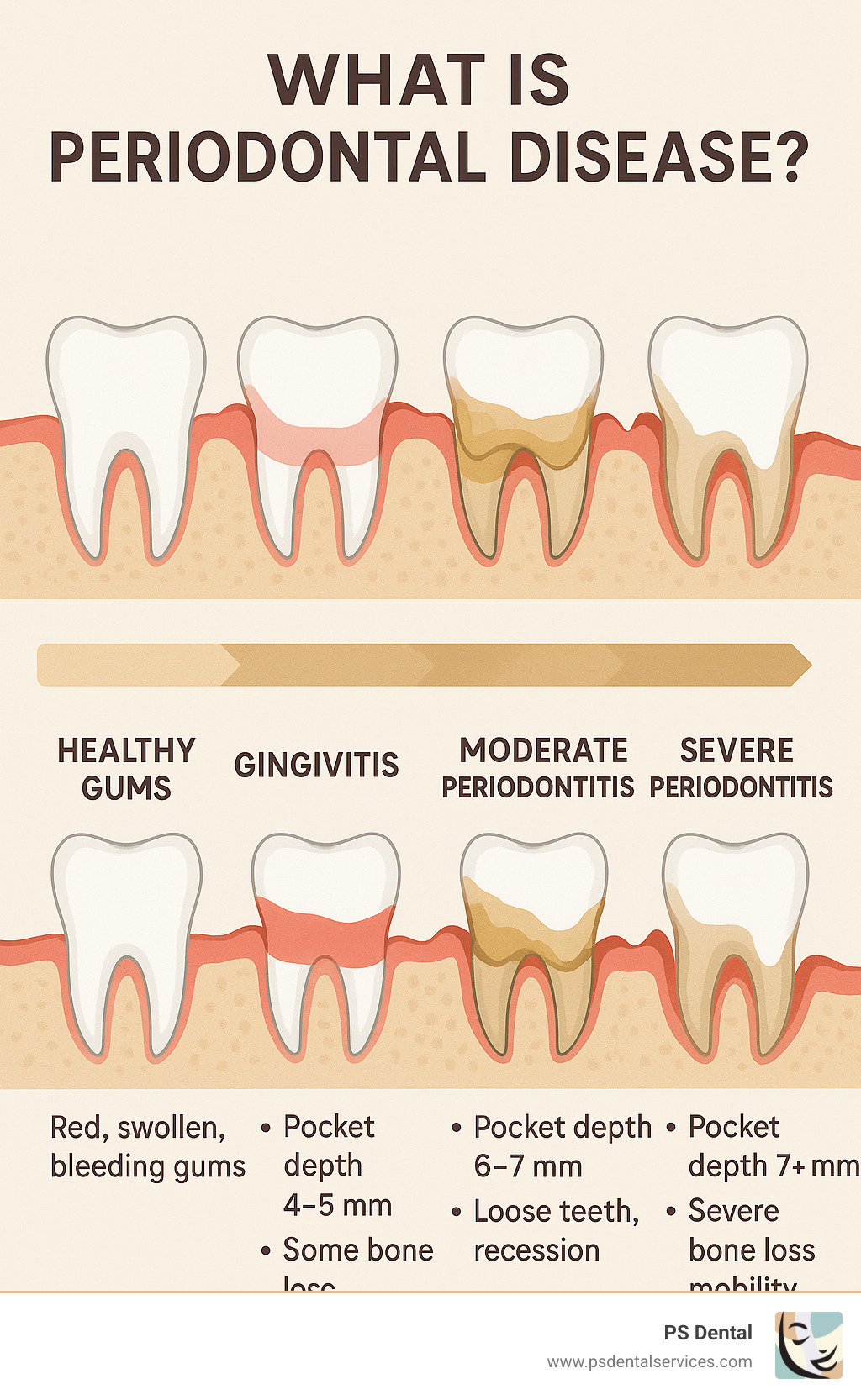 Infographic showing the progression of periodontal disease from healthy gums through gingivitis to mild, moderate, and severe periodontitis, including pocket depth measurements, bone loss indicators, and key symptoms at each stage - what is periodontal disease infographic 
