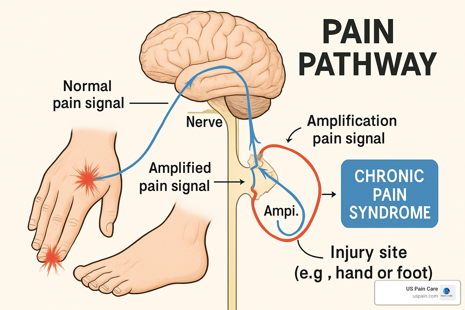 Diagram showing pain pathway from injury site through spinal cord to brain, with labels for different types of pain signals and how they can become amplified in chronic pain syndrome - chronic pain syndrome