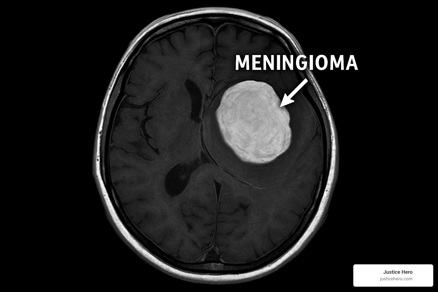 Brain scan showing meningioma location and pressure effects - depo-provera brain tumor symptoms Brain scan showing meningioma location and pressure effects - depo-provera brain tumor symptoms