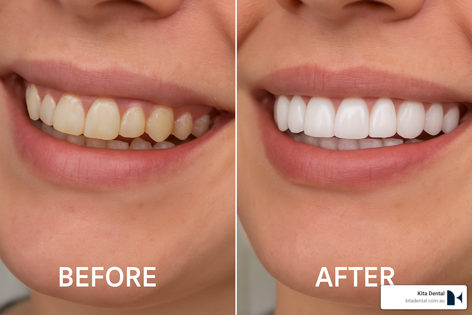 Before and after comparison showing dramatic smile change with porcelain veneers - teeth whitening campbelltown Before and after comparison showing dramatic smile change with porcelain veneers - teeth whitening campbelltown