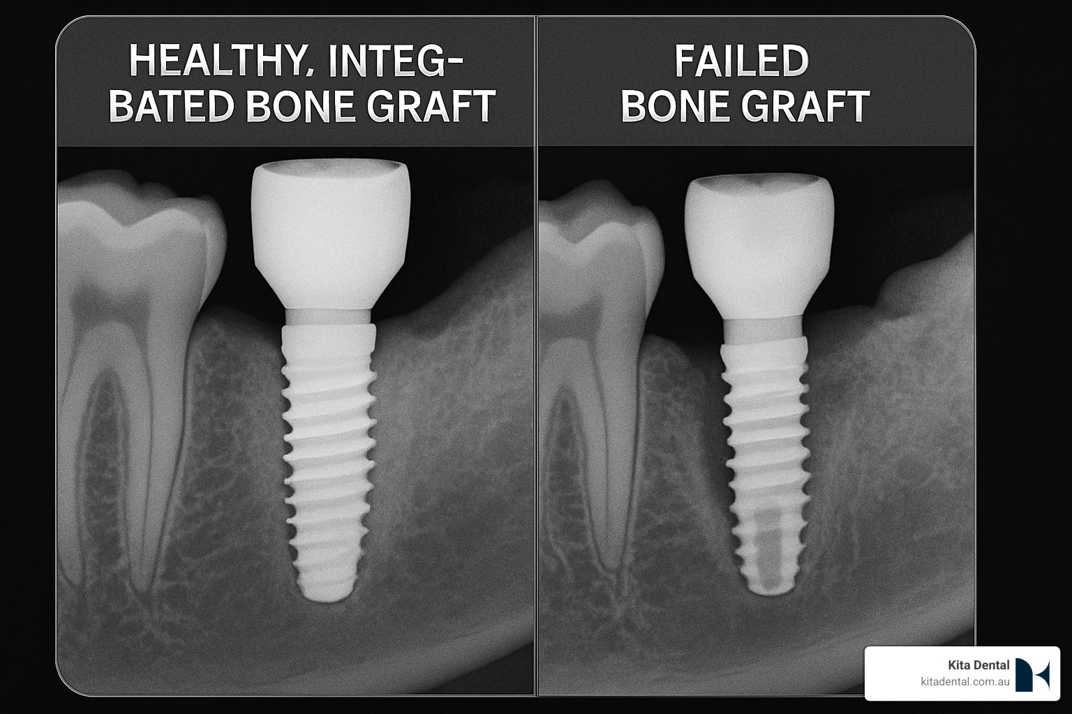 healthy vs failed bone graft comparison - bone graft dental implant healthy vs failed bone graft comparison - bone graft dental implant
