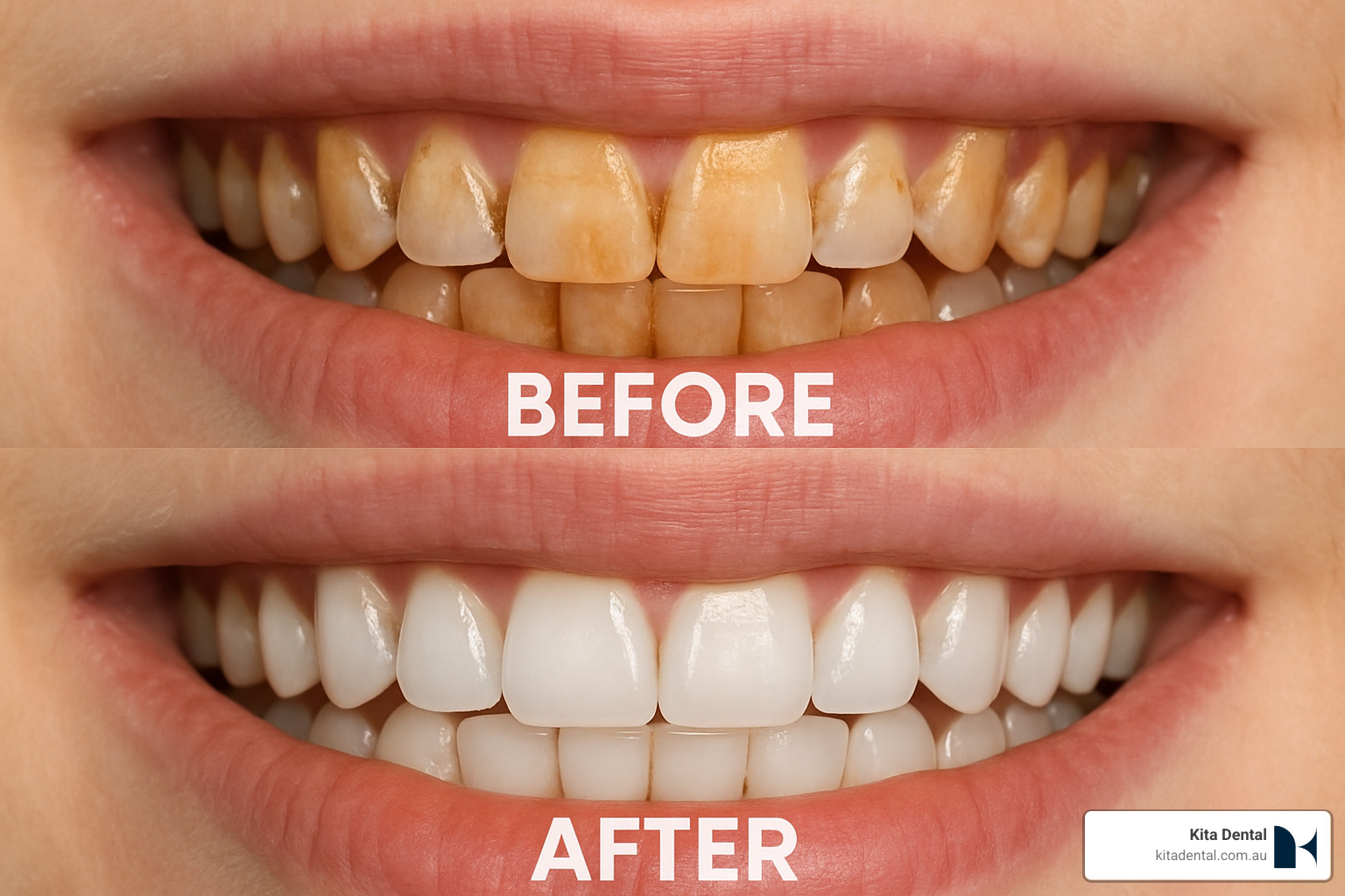 before and after comparison of teeth showing stain removal through polishing - benefits of scaling and polishing