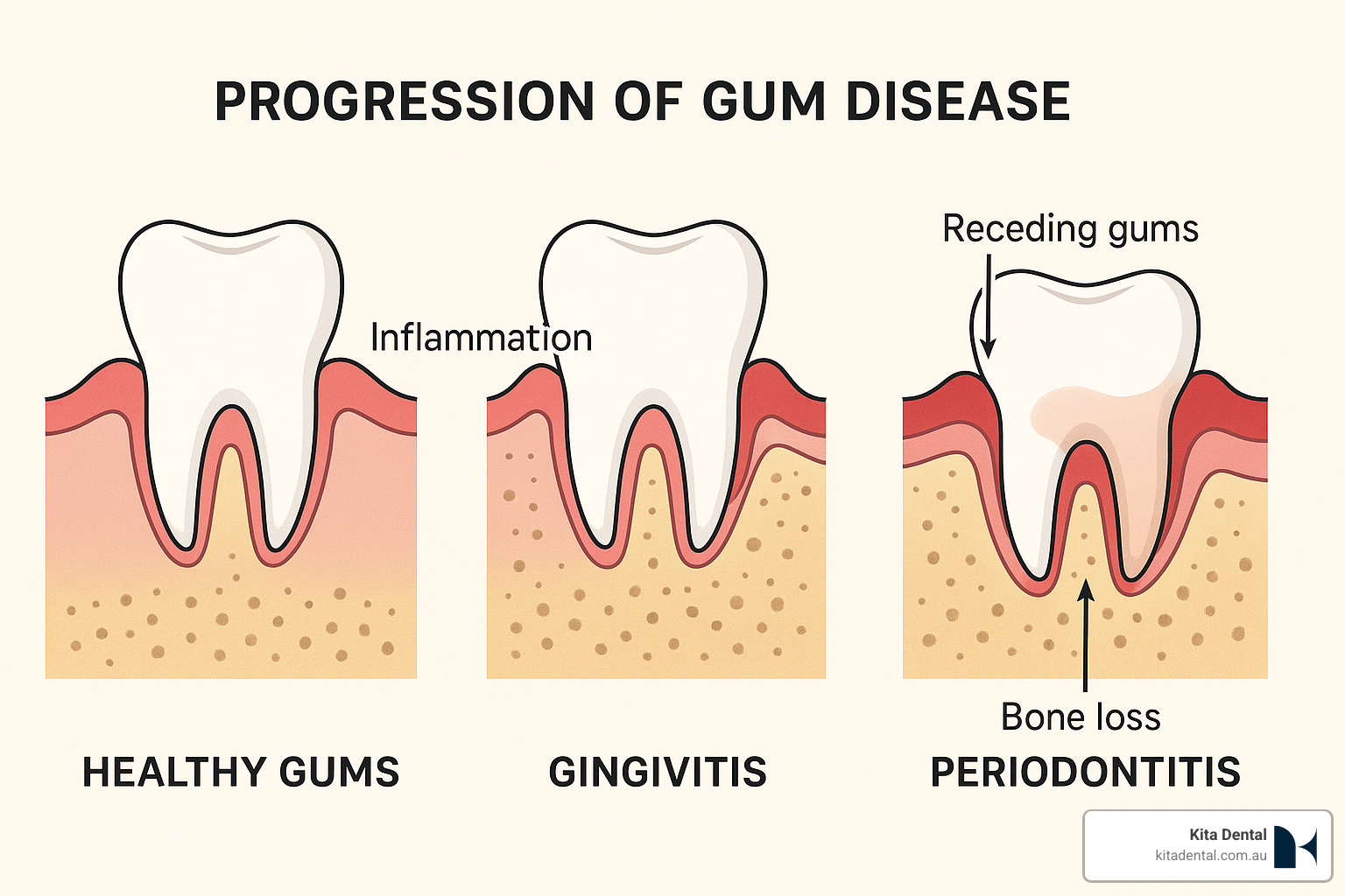 progression of gum disease from healthy gums to gingivitis to periodontitis - benefits of scaling and polishing