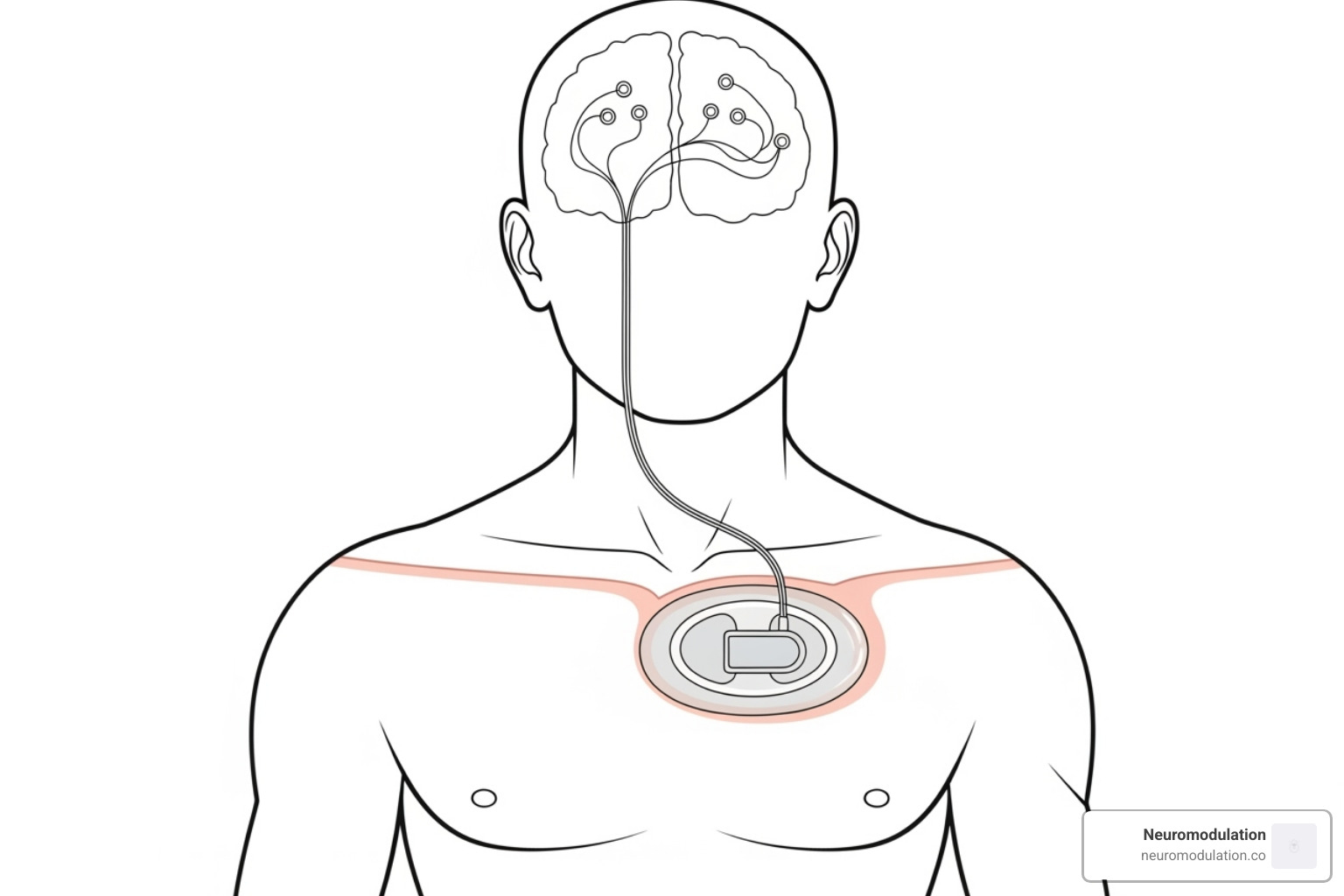 Diagram showing the implanted pulse generator (IPG) under the collarbone, connected by an extension wire to the lead with electrodes implanted in the brain - deep brain stimulation (dbs)