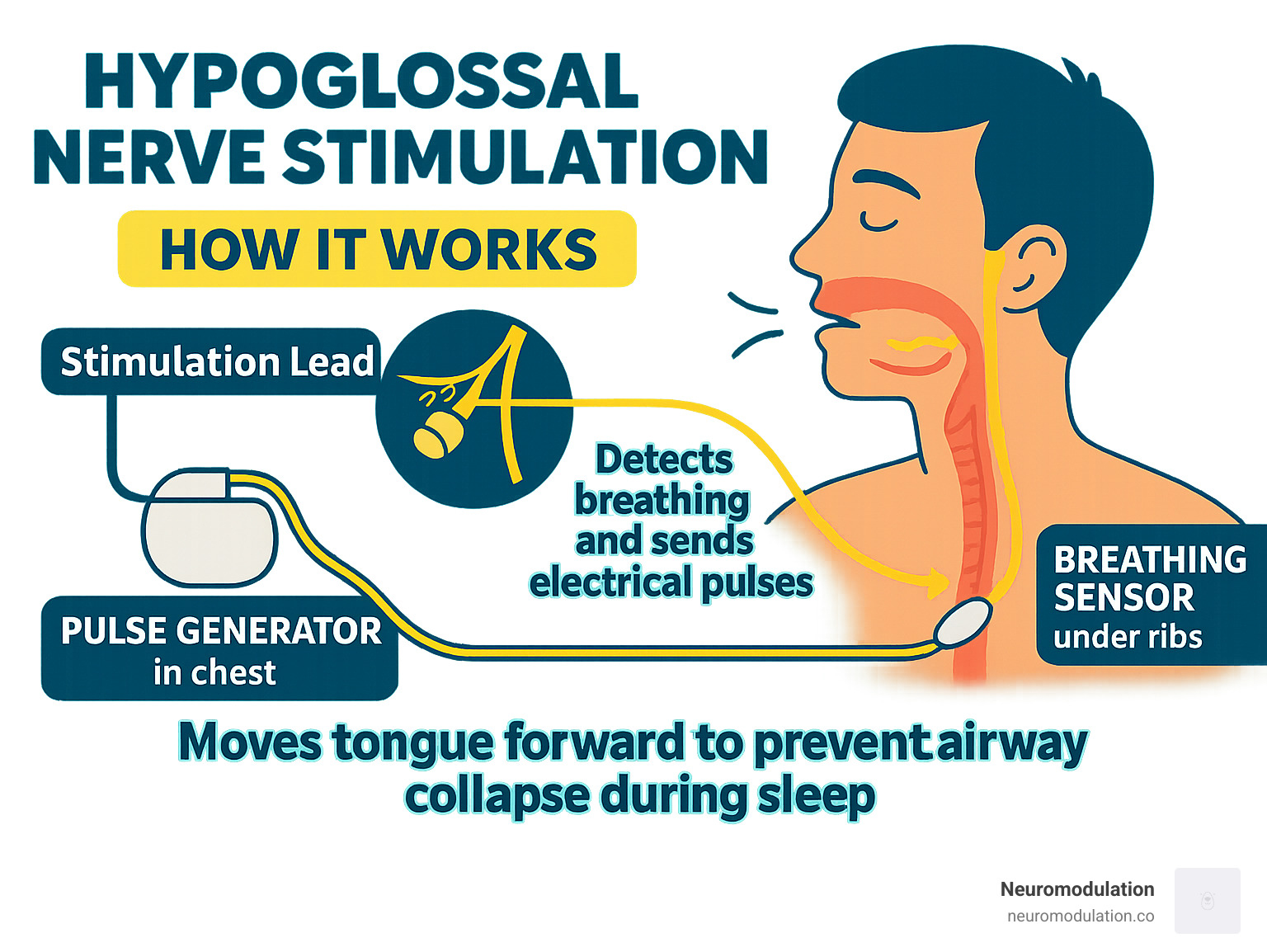 Infographic showing how hypoglossal nerve stimulation works: a small implanted device detects breathing and sends electrical pulses to the hypoglossal nerve, which moves the tongue forward to prevent airway collapse during sleep, with three main components - pulse generator in chest, breathing sensor under ribs, and stimulation lead around the nerve - hypoglossal nerve stimulation infographic 