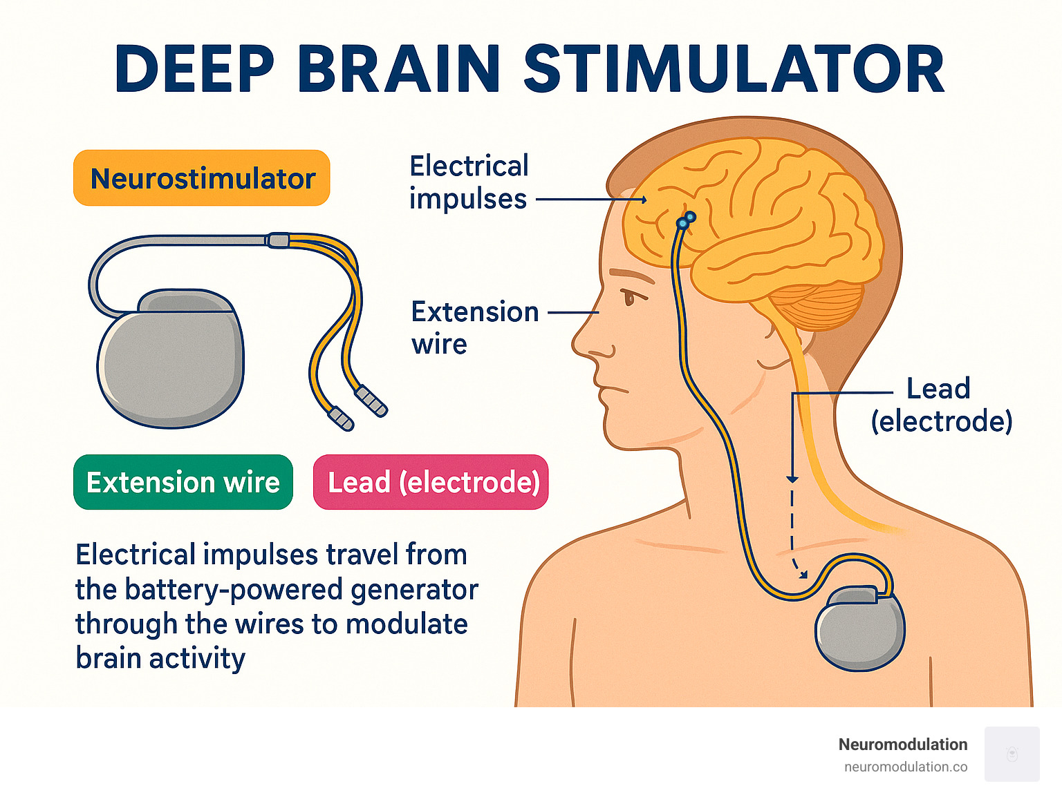 Detailed diagram showing the three main components of a DBS system: the lead electrode placed in targeted brain regions, the extension wire running under the skin, and the neurostimulator device implanted in the chest area, with labels explaining how electrical impulses travel from the battery-powered generator through the wires to modulate brain activity - Deep brain stimulator infographic Detailed diagram showing the three main components of a DBS system: the lead electrode placed in targeted brain regions, the extension wire running under the skin, and the neurostimulator device implanted in the chest area, with labels explaining how electrical impulses travel from the battery-powered generator through the wires to modulate brain activity - Deep brain stimulator infographic