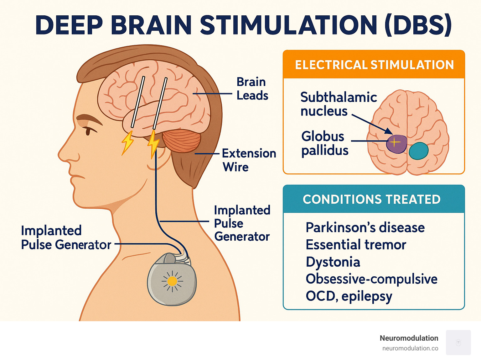 Comprehensive infographic showing DBS system components including implanted pulse generator under collarbone, extension wire, and brain leads with electrical stimulation targeting specific brain regions like subthalamic nucleus and globus pallidus for treating Parkinson's disease, essential tremor, dystonia, OCD and epilepsy - deep brain stimulation (dbs) infographic 