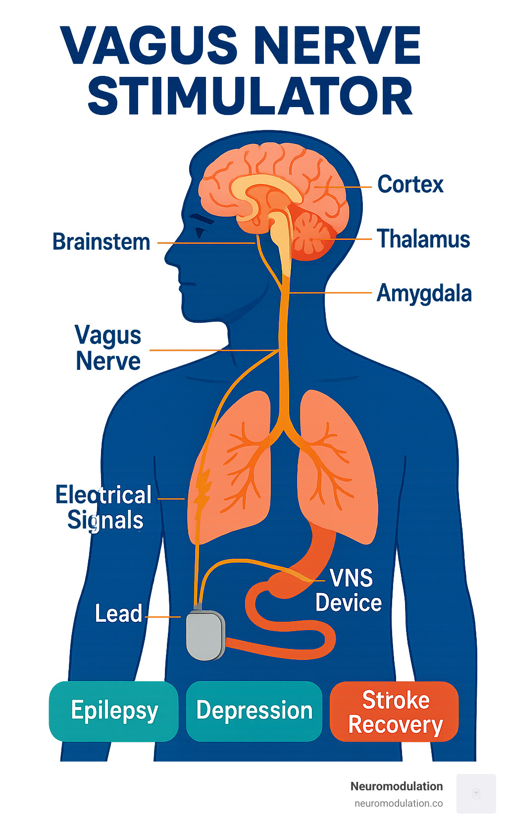 Detailed infographic showing the vagus nerve pathway from brainstem through neck to chest and abdomen, with VNS device placement and electrical signal transmission to brain regions for treating epilepsy, depression, and stroke recovery - Vagus nerve stimulator infographic 