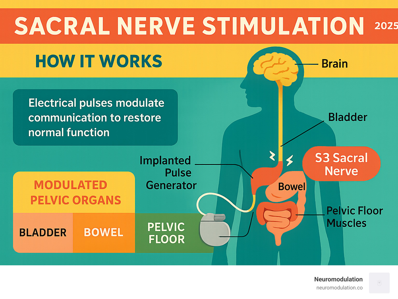 Comprehensive infographic showing how sacral nerve stimulation works by sending electrical pulses through implanted leads to the S3 sacral nerve, which then modulates communication between the brain and pelvic organs including the bladder, bowel, and pelvic floor muscles to restore normal function - sacral nerve stimulation infographic 