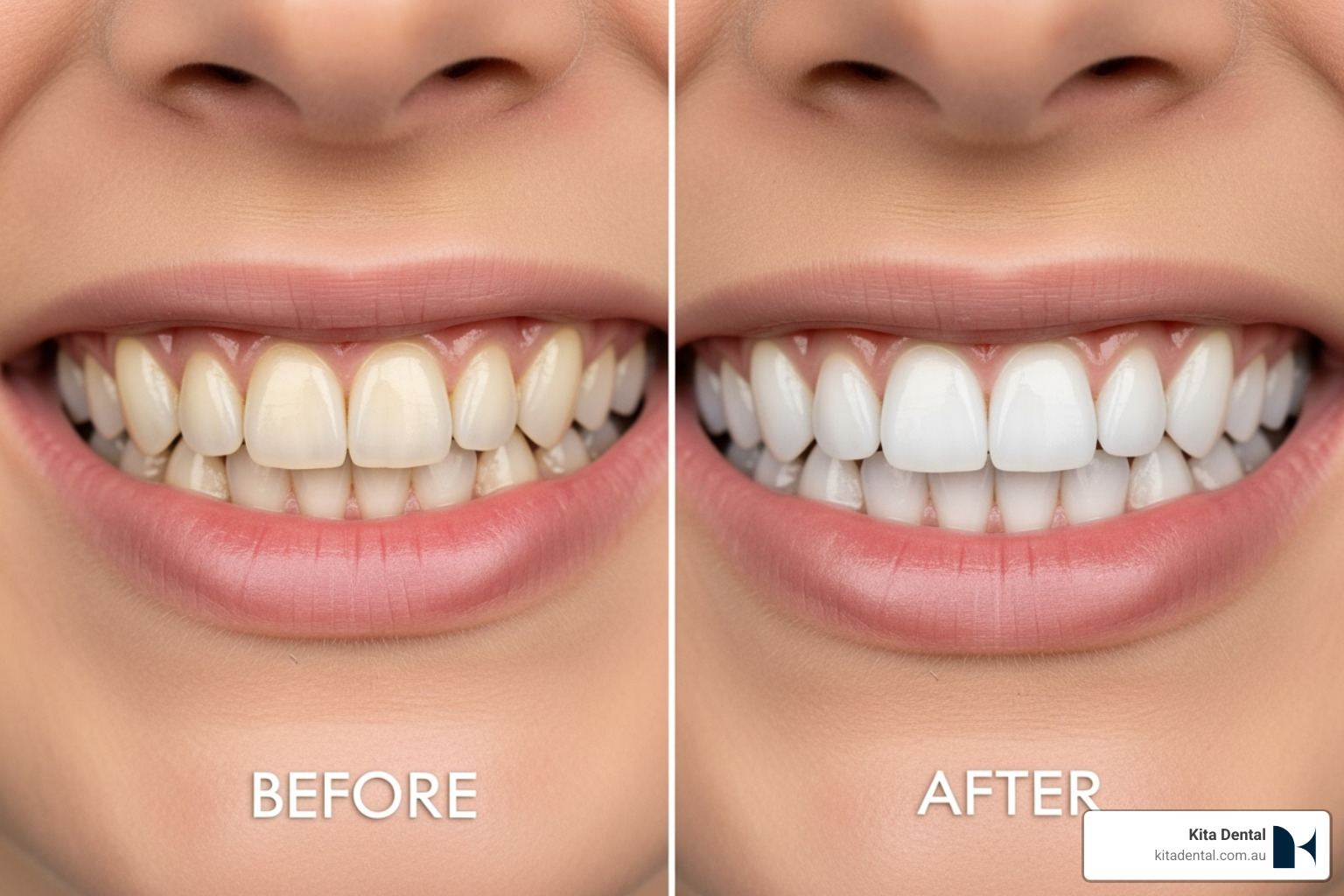 A before-and-after comparison of teeth whitening results, showcasing the significant improvement in tooth brightness and overall smile aesthetics - how much does teeth whitening cost sydney A before-and-after comparison of teeth whitening results, showcasing the significant improvement in tooth brightness and overall smile aesthetics - how much does teeth whitening cost sydney