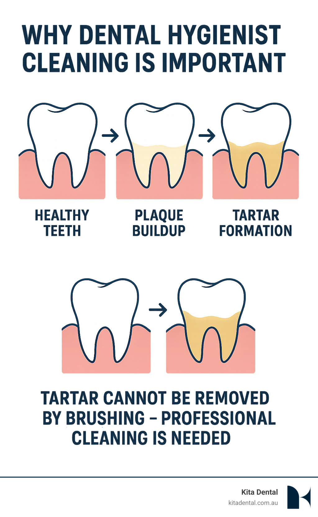 Infographic showing the progression from healthy teeth to plaque buildup to tartar formation, illustrating why professional dental hygienist cleaning is necessary to remove hardened tartar that regular brushing cannot eliminate - dental hygienist sydney infographic Infographic showing the progression from healthy teeth to plaque buildup to tartar formation, illustrating why professional dental hygienist cleaning is necessary to remove hardened tartar that regular brushing cannot eliminate - dental hygienist sydney infographic