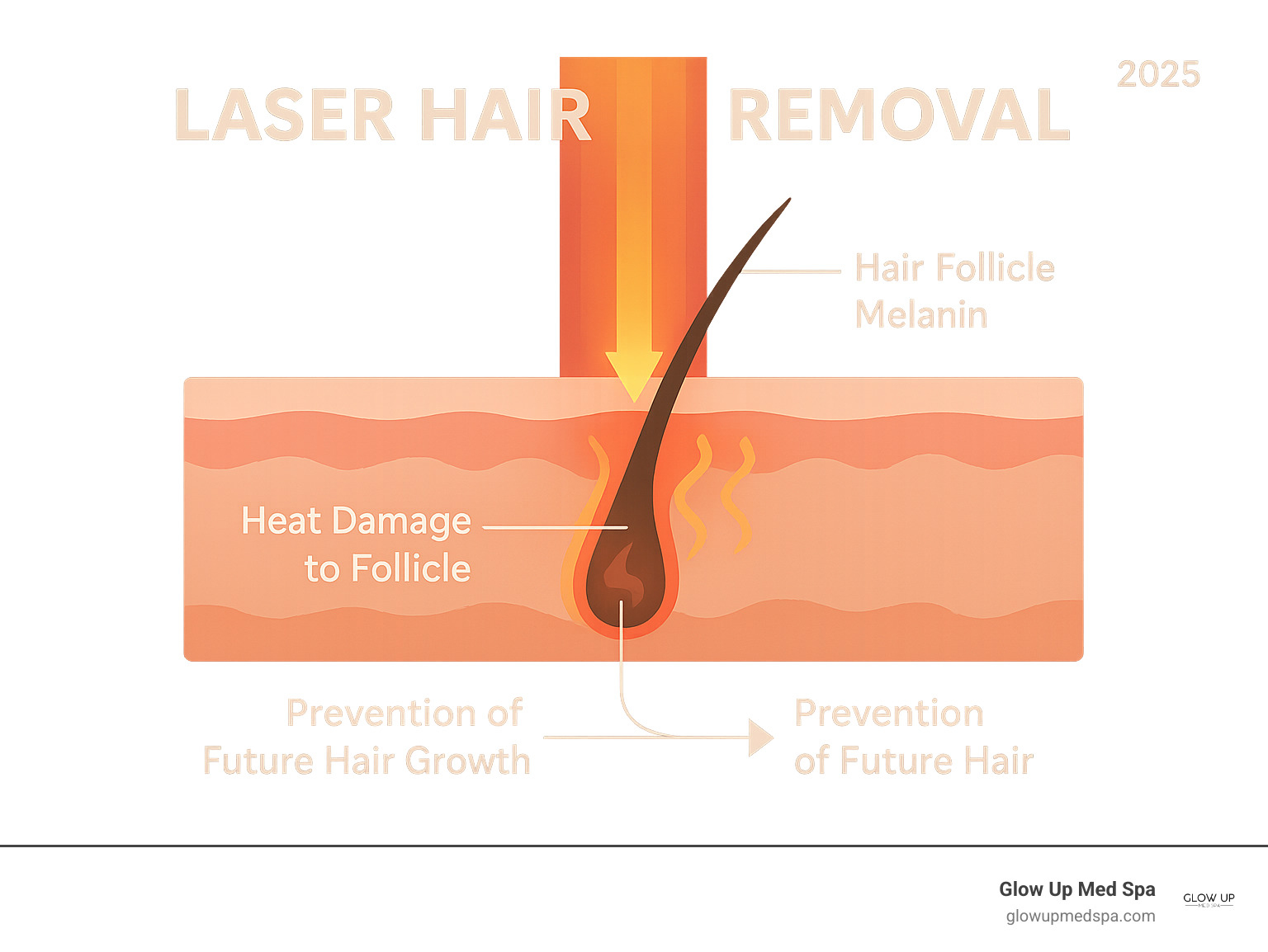 Infographic showing laser light penetrating skin to target hair follicle melanin, with arrows indicating heat damage to the follicle structure and prevention of future hair growth - laser hair removal orange county infographic 