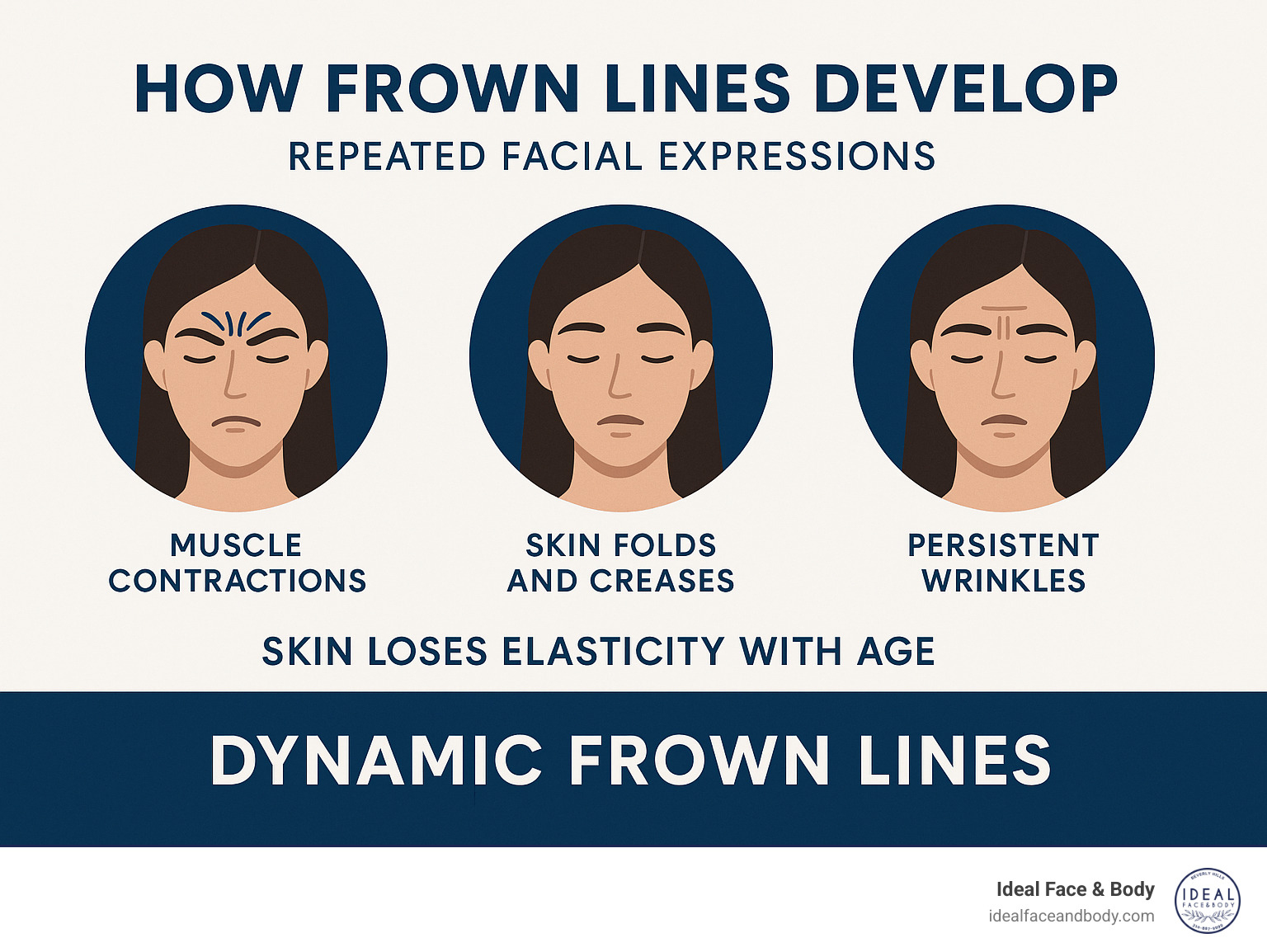 Infographic showing how repeated facial expressions create dynamic frown lines over time, with muscle contractions causing skin to fold and crease, leading to persistent wrinkles as skin loses elasticity with age - xeomin frown lines infographic 