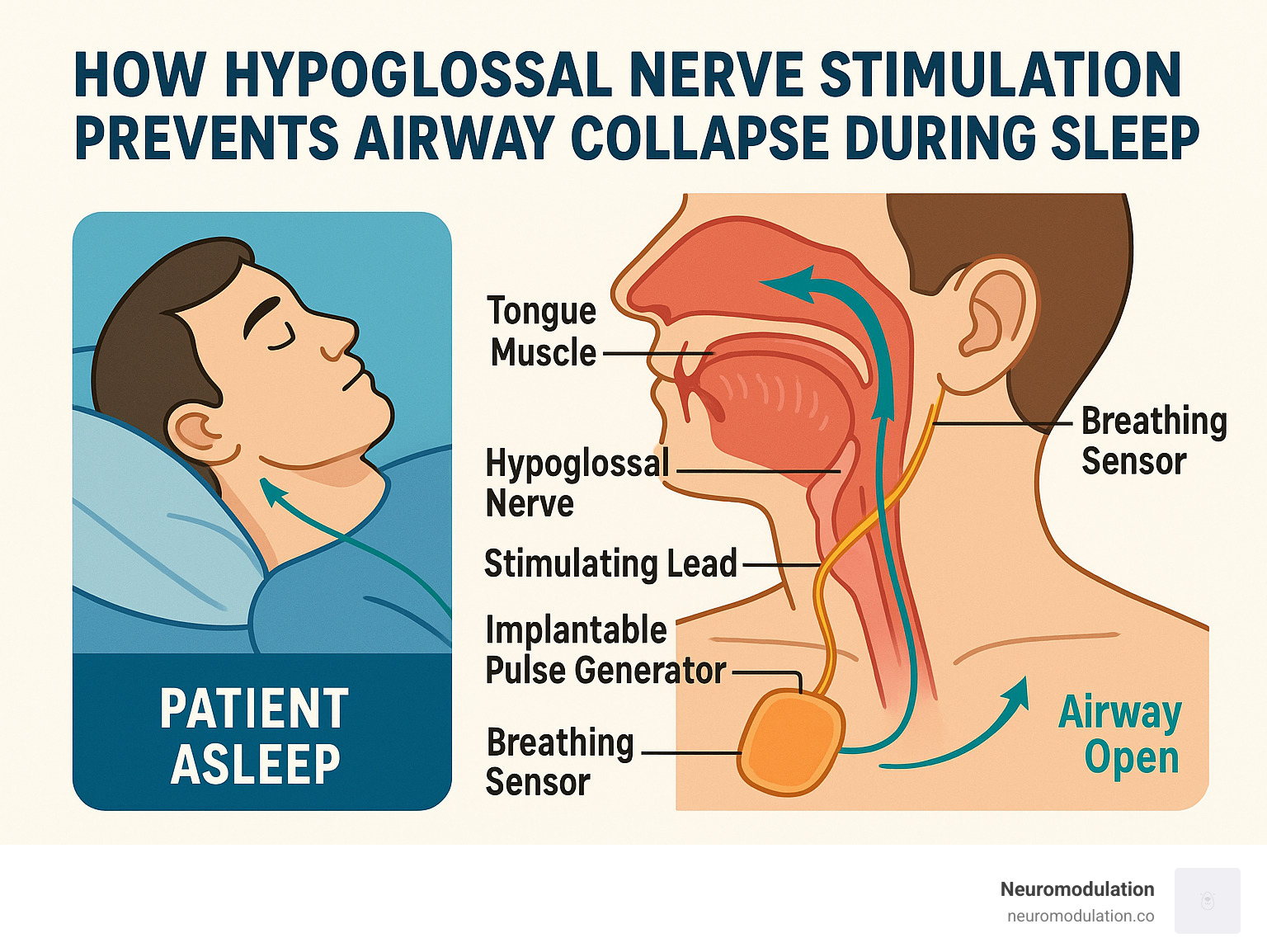 Detailed infographic showing how hypoglossal nerve stimulation prevents airway collapse during sleep by stimulating tongue muscles to maintain open airway, including device components and patient sleep cycle - hypoglossal nerve stimulator therapy infographic 
