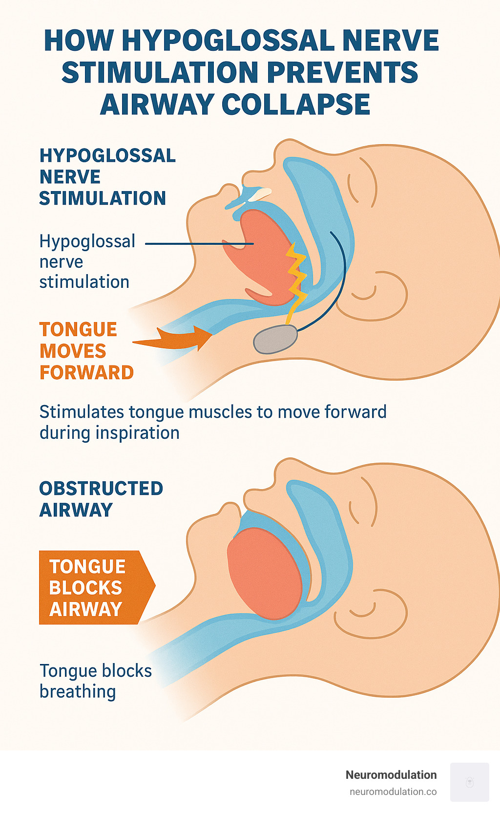 Detailed infographic showing how hypoglossal nerve stimulation prevents airway collapse by stimulating tongue muscles to move forward during inspiration, compared to an obstructed airway where the tongue blocks breathing - hypoglossal nerve stimulation device infographic Detailed infographic showing how hypoglossal nerve stimulation prevents airway collapse by stimulating tongue muscles to move forward during inspiration, compared to an obstructed airway where the tongue blocks breathing - hypoglossal nerve stimulation device infographic