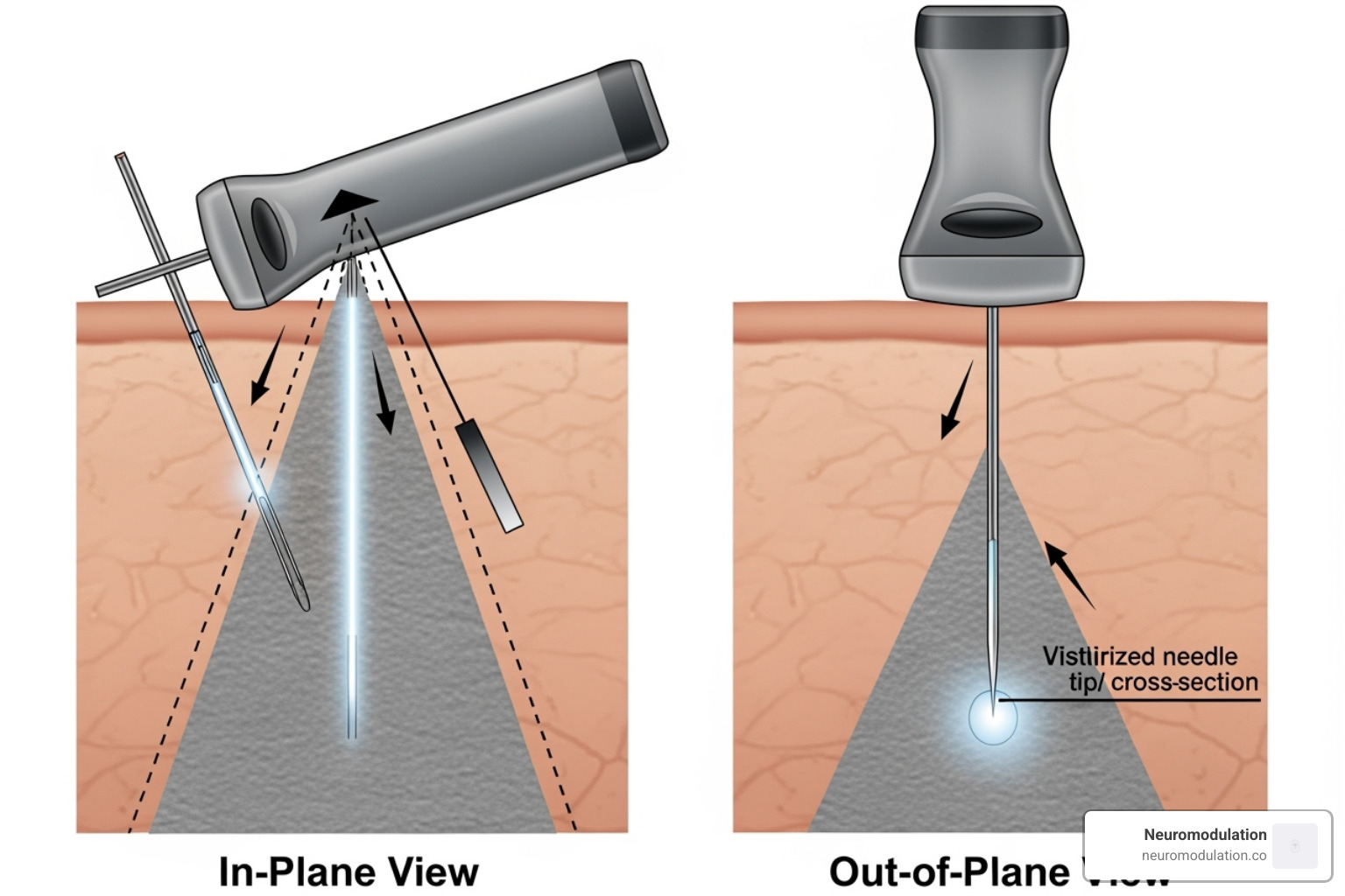 Image showing the in-plane vs. out-of-plane needle approach - ultrasound guided blocks Image showing the in-plane vs. out-of-plane needle approach - ultrasound guided blocks