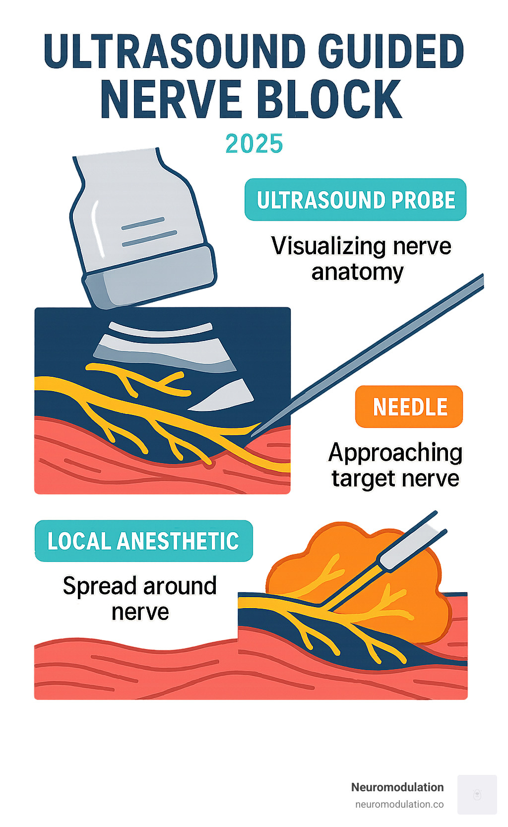 Infographic showing ultrasound-guided nerve block procedure with three key components: ultrasound probe visualizing nerve anatomy in real-time, needle positioned under direct visualization approaching target nerve, and local anesthetic spread around nerve structure with clear distribution pattern - ultrasound guided blocks infographic Infographic showing ultrasound-guided nerve block procedure with three key components: ultrasound probe visualizing nerve anatomy in real-time, needle positioned under direct visualization approaching target nerve, and local anesthetic spread around nerve structure with clear distribution pattern - ultrasound guided blocks infographic