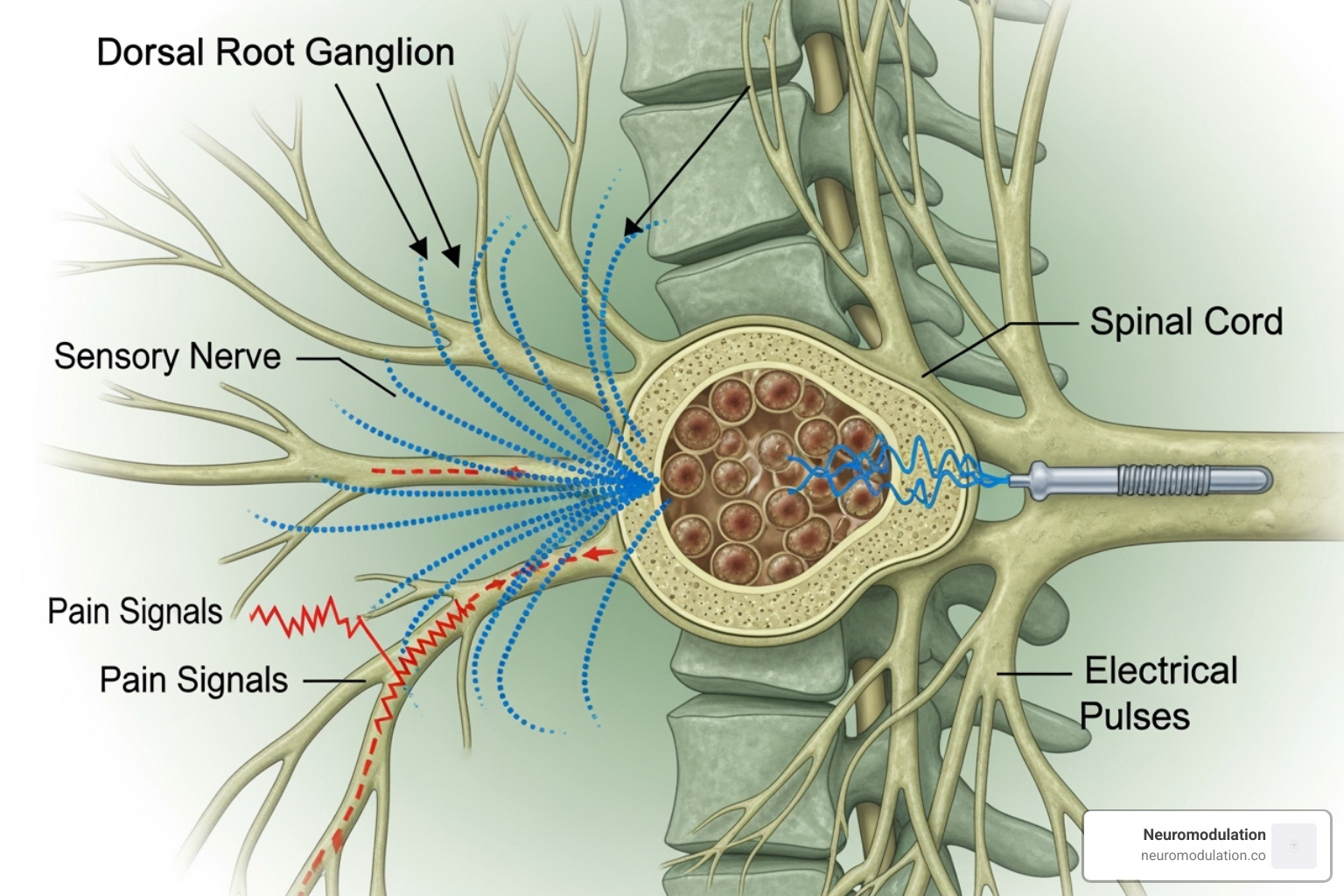 DRG stimulation blocking pain signals - neuromodulation of the dorsal root ganglion for chronic post-surgical pain