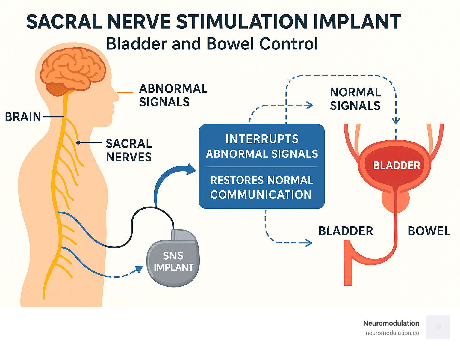 Detailed infographic showing the pathway from brain to sacral nerves to bladder and bowel, illustrating how SNS implant interrupts abnormal signals and restores normal communication for proper bladder and bowel control - sacral nerve stimulation implant infographic 