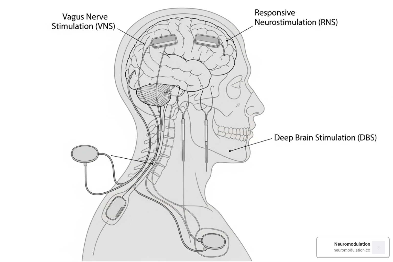 Placement of neuromodulation devices on a human silhouette - neuromodulation for epilepsy