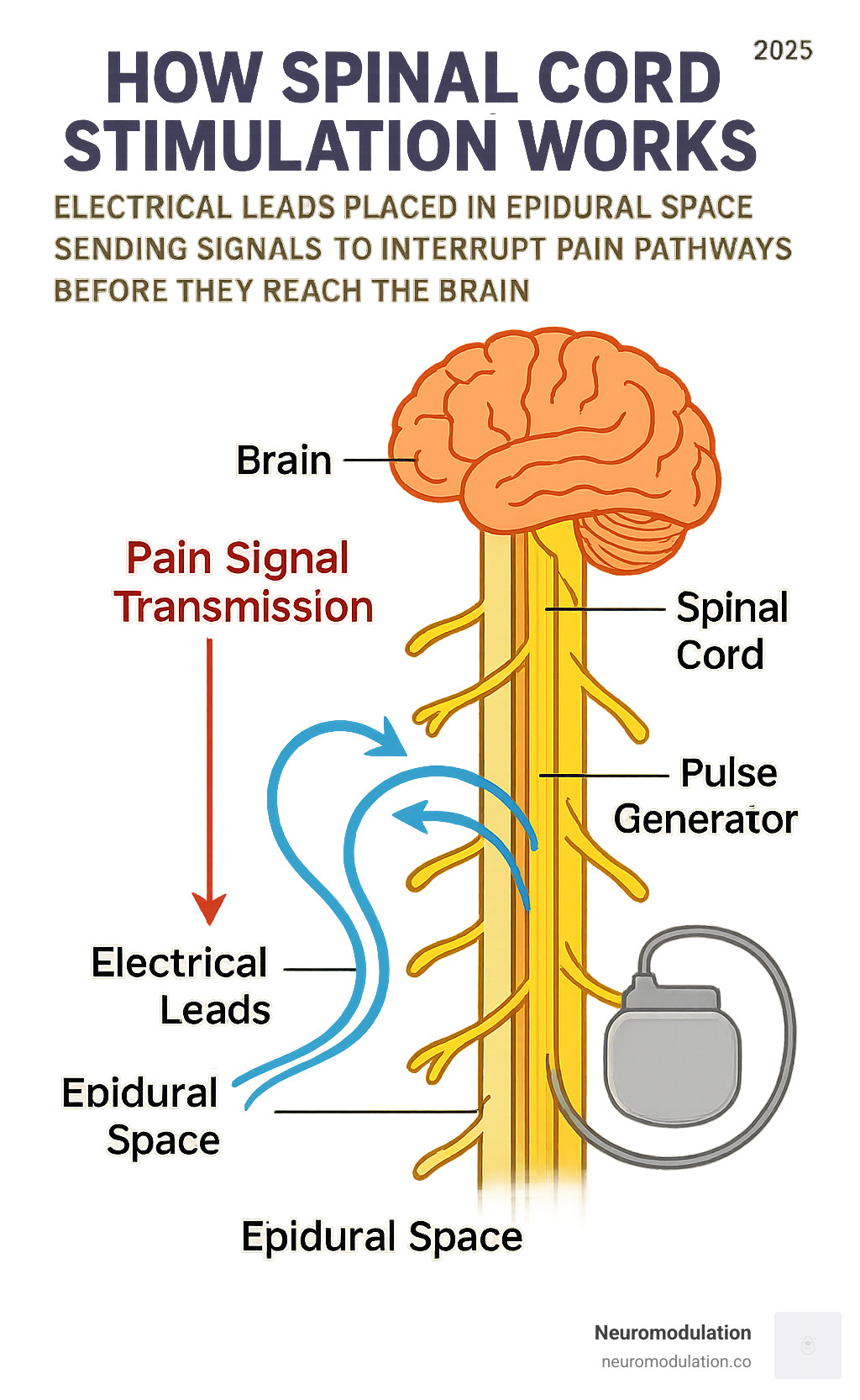 Detailed infographic showing how spinal cord stimulation works: electrical leads placed in epidural space sending signals to interrupt pain pathways before they reach the brain, with labeled anatomy of spinal cord, nerve roots, and pain signal transmission - spinal cord stimulator infographic 