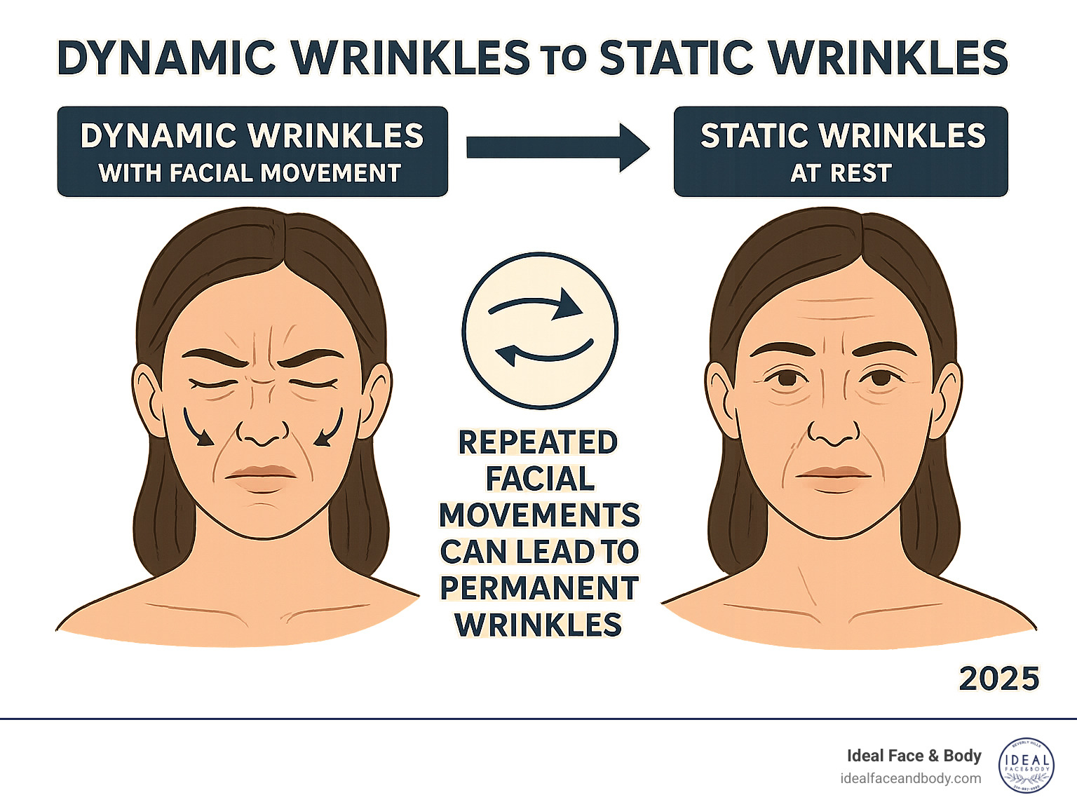 Infographic showing how repeated facial muscle contractions from expressions like frowning and squinting create dynamic wrinkles that move with facial movement, which over time become static wrinkles permanently etched into the skin even at rest, illustrating the progression from temporary expression lines to permanent wrinkles - preventative xeomin infographic 