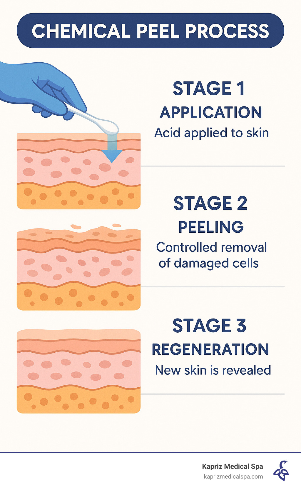 Infographic showing the three-stage chemical peel process: Stage 1 shows acid application penetrating skin layers, Stage 2 displays controlled peeling of damaged surface cells, and Stage 3 reveals fresh new skin with improved texture and tone - chemical peel before after infographic Infographic showing the three-stage chemical peel process: Stage 1 shows acid application penetrating skin layers, Stage 2 displays controlled peeling of damaged surface cells, and Stage 3 reveals fresh new skin with improved texture and tone - chemical peel before after infographic