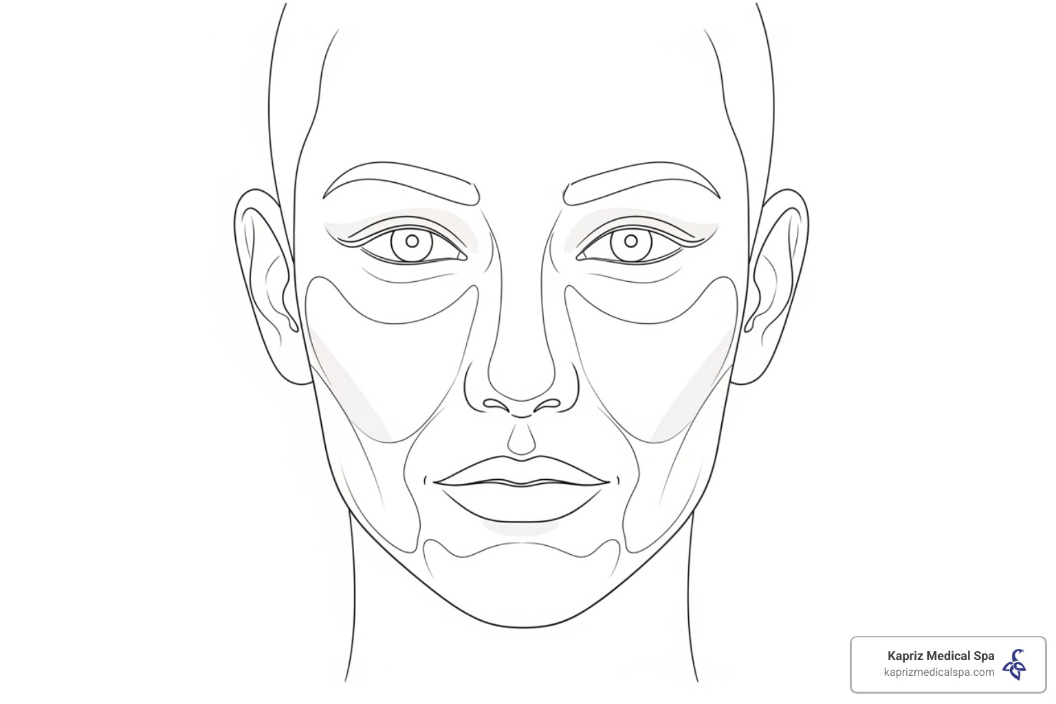 common treatment areas for Sculptra on a face diagram - sculptra injections