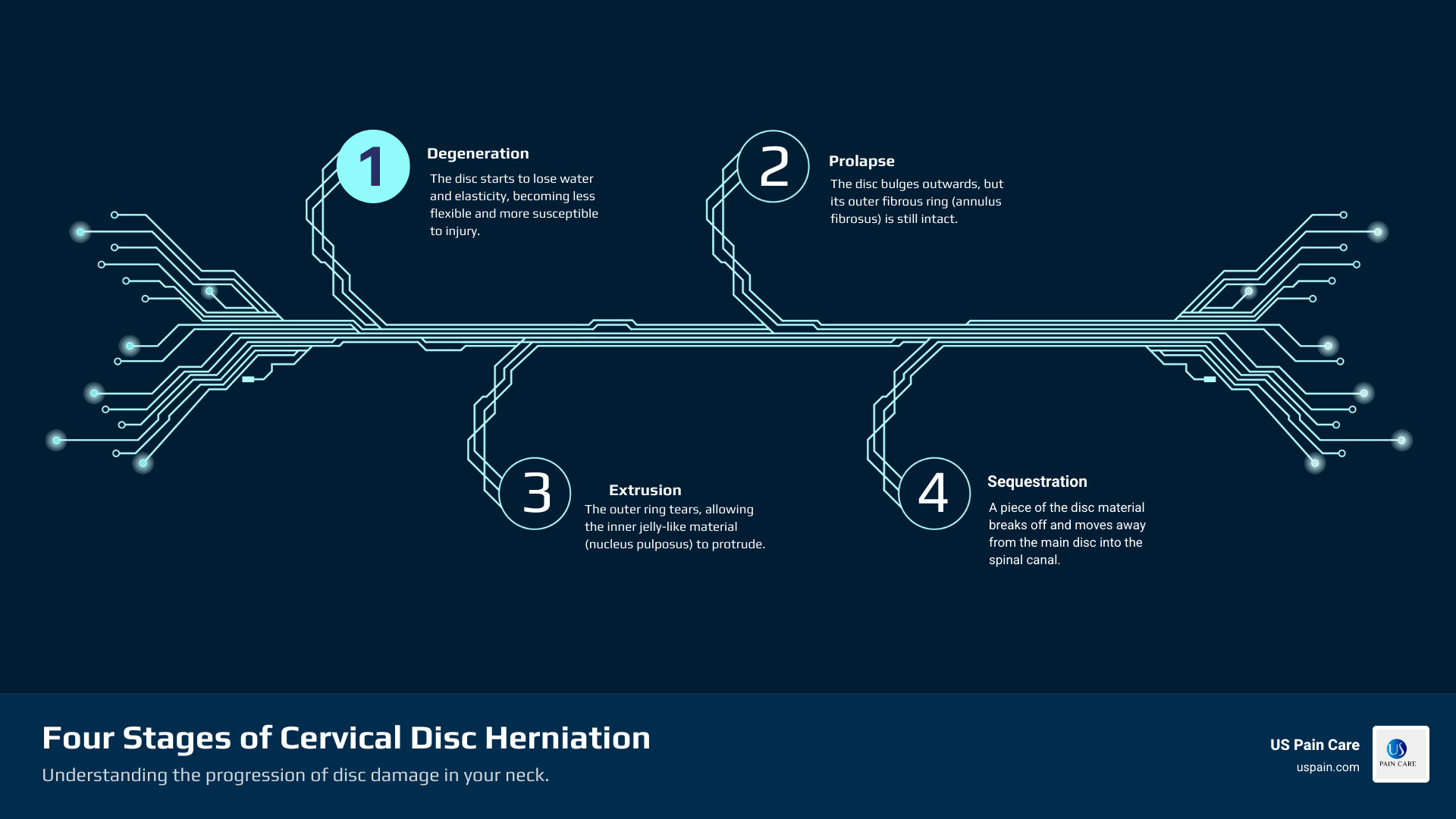 Four stages of cervical disc herniation: degeneration, prolapse, extrusion, and sequestration - cervical disc herniation infographic infographic-4-steps-tech