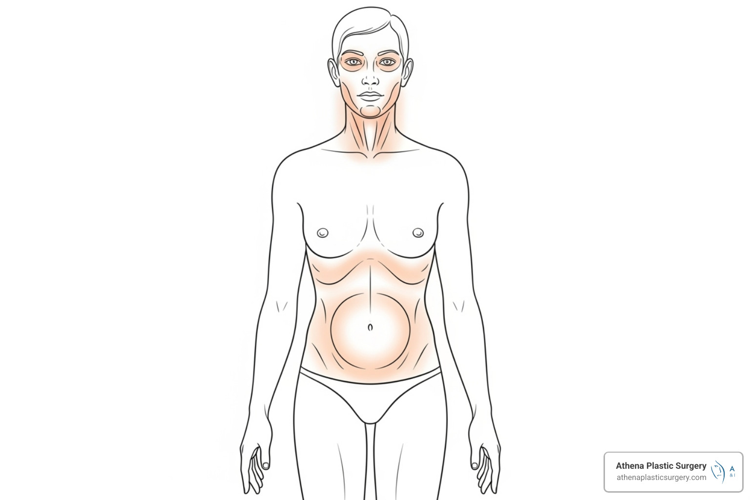 Diagram showing common Thermage treatment areas on the face and body - thermage treatment