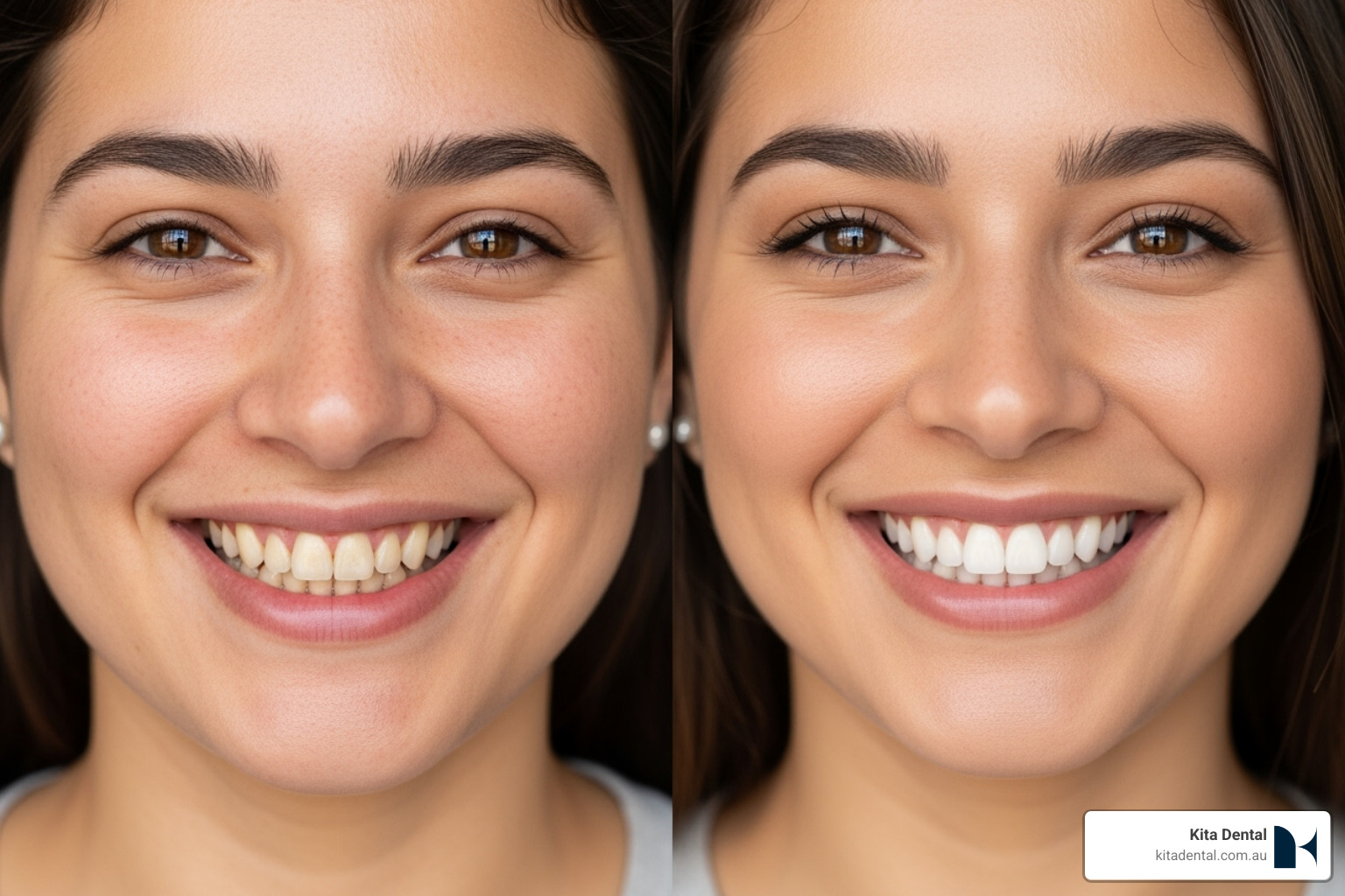before-and-after smile changes - cosmetic dentist macquarie street sydney before-and-after smile changes - cosmetic dentist macquarie street sydney
