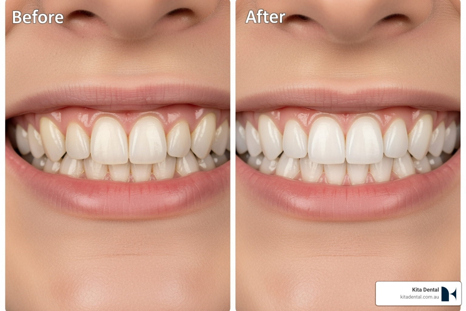 before-and-after smile change with porcelain veneers - gentle dental care sydney before-and-after smile change with porcelain veneers - gentle dental care sydney