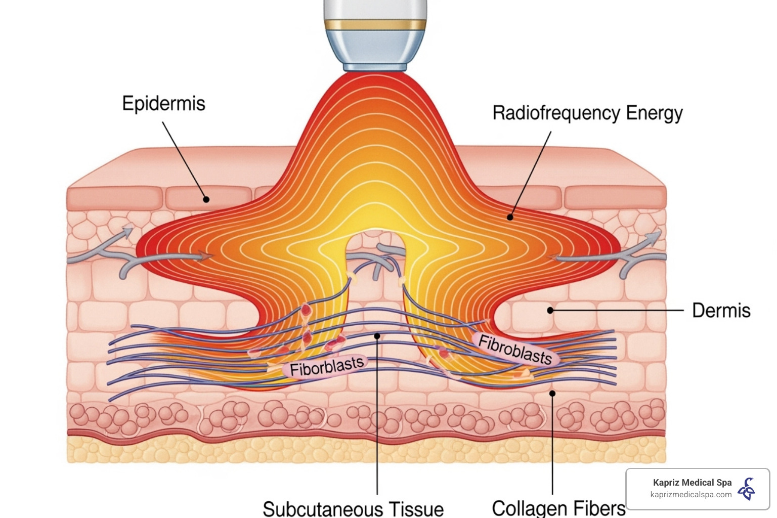 illustrating how radiofrequency energy penetrates skin layers to stimulate collagen - Body contouring skin tightening illustrating how radiofrequency energy penetrates skin layers to stimulate collagen - Body contouring skin tightening