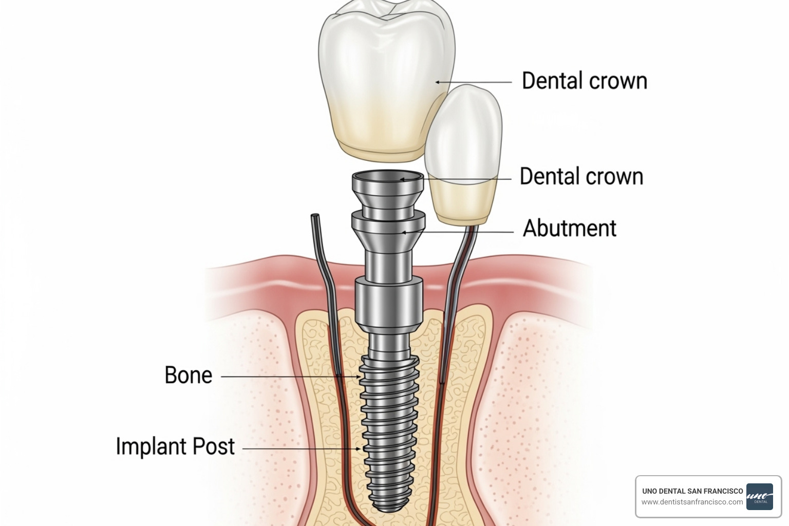 Diagram showing the components of a dental implant: titanium screw (implant), abutment, and crown - how much do restorative dentistry services cost Diagram showing the components of a dental implant: titanium screw (implant), abutment, and crown - how much do restorative dentistry services cost