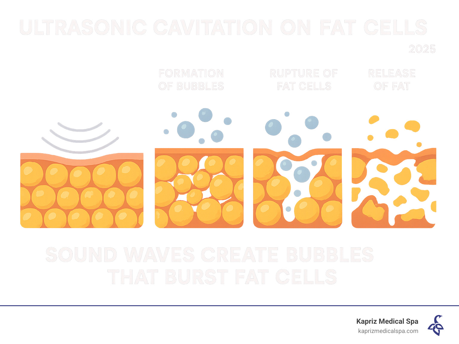 Infographic explaining the process of ultrasonic cavitation on fat cells - lipo cavitation jacksonville fl infographic Infographic explaining the process of ultrasonic cavitation on fat cells - lipo cavitation jacksonville fl infographic
