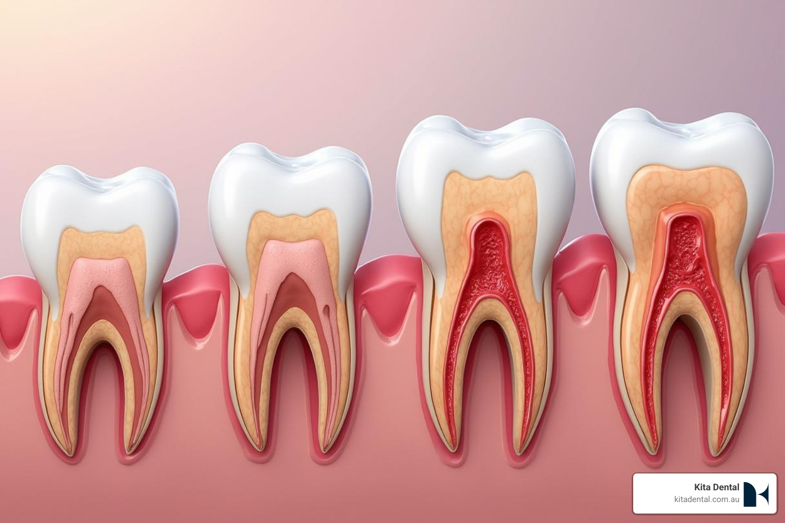 Progression of gum disease from healthy gums to advanced periodontitis, showing increasing inflammation, pocket formation, and bone loss Progression of gum disease from healthy gums to advanced periodontitis, showing increasing inflammation, pocket formation, and bone loss