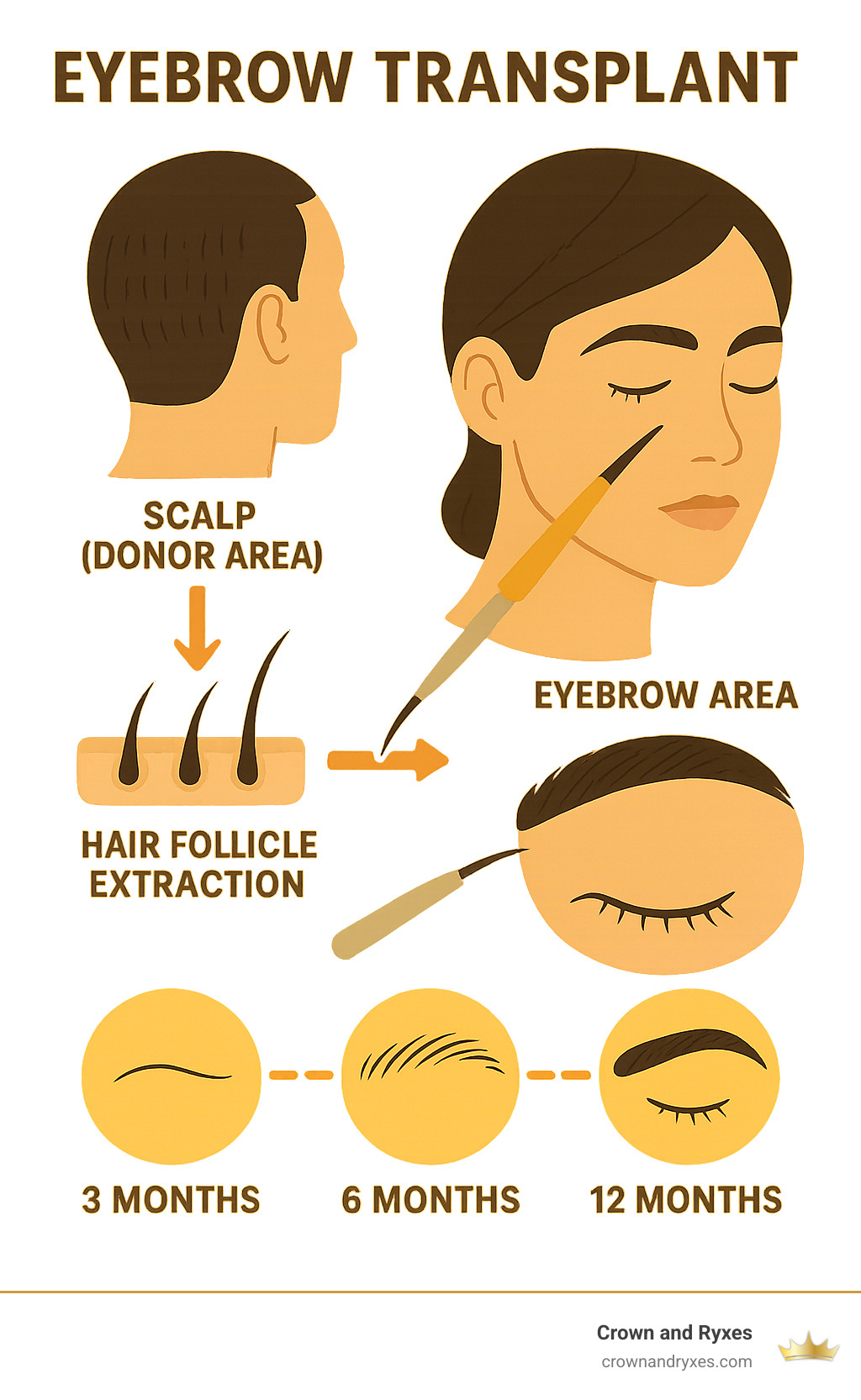 Infographic showing hair follicle extraction from scalp donor area and transplantation to eyebrow area with arrows indicating the transfer process and timeline of results - can you get hair implants on your eyebrows infographic Infographic showing hair follicle extraction from scalp donor area and transplantation to eyebrow area with arrows indicating the transfer process and timeline of results - can you get hair implants on your eyebrows infographic