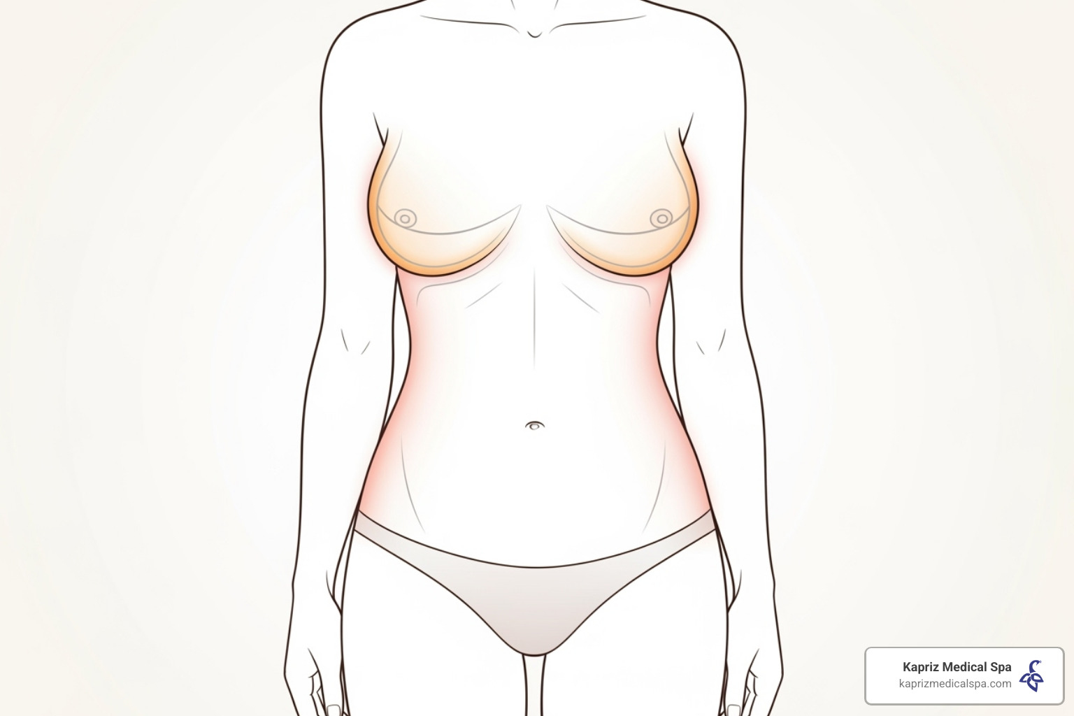 Illustration showing areas treated in a Mommy Makeover including breasts, abdomen, and sometimes thighs or arms - tummy tuck cost jacksonville fl