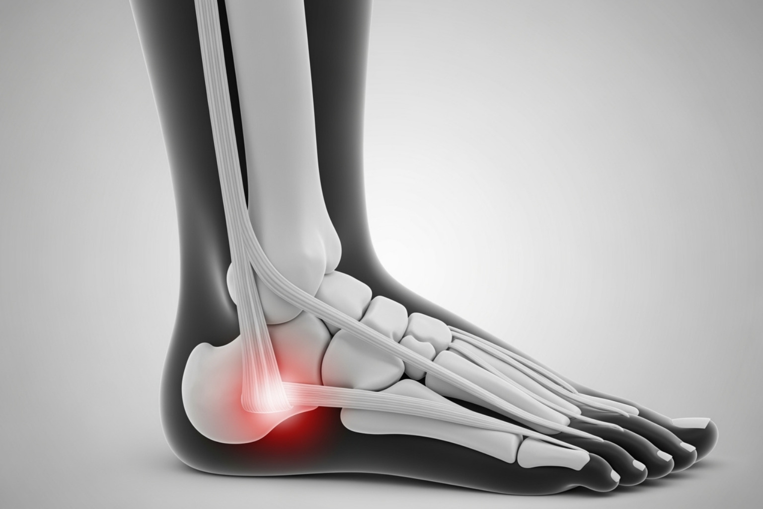 illustration of plantar fascia pain - heel pain