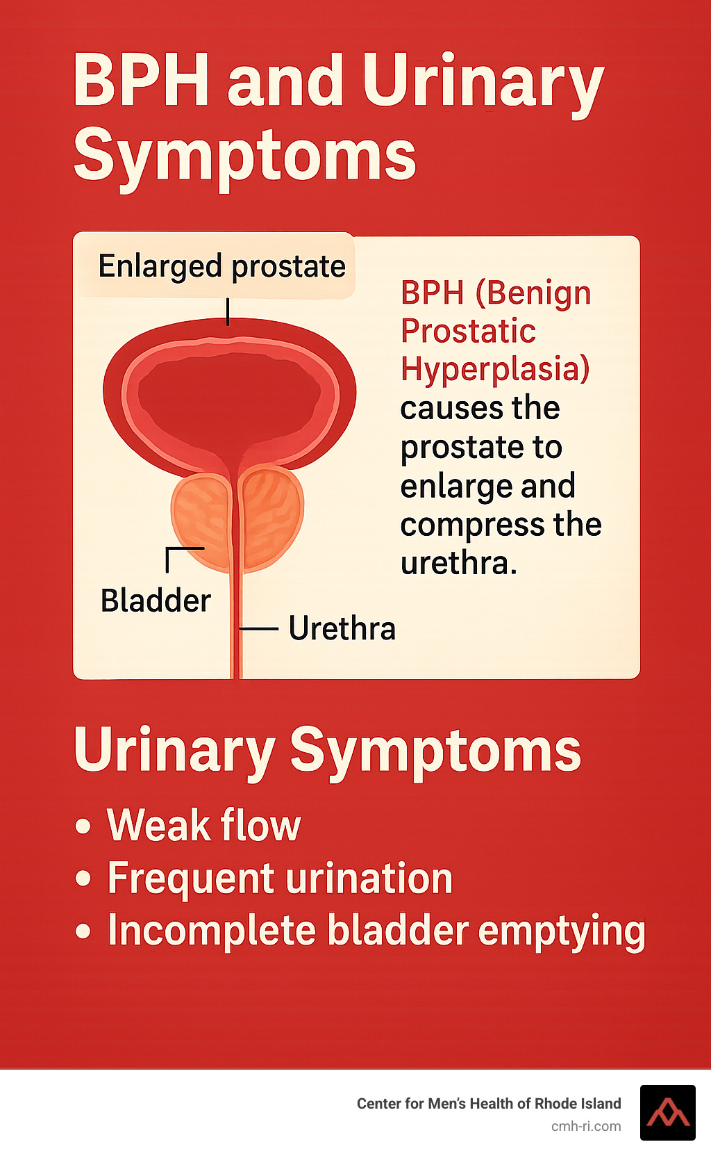 Infographic showing the location of the prostate gland below the bladder, surrounding the urethra, and how BPH causes the prostate to enlarge and compress the urethra, leading to urinary symptoms like weak flow, frequent urination, and incomplete bladder emptying - BPH specialist near me infographic Infographic showing the location of the prostate gland below the bladder, surrounding the urethra, and how BPH causes the prostate to enlarge and compress the urethra, leading to urinary symptoms like weak flow, frequent urination, and incomplete bladder emptying - BPH specialist near me infographic