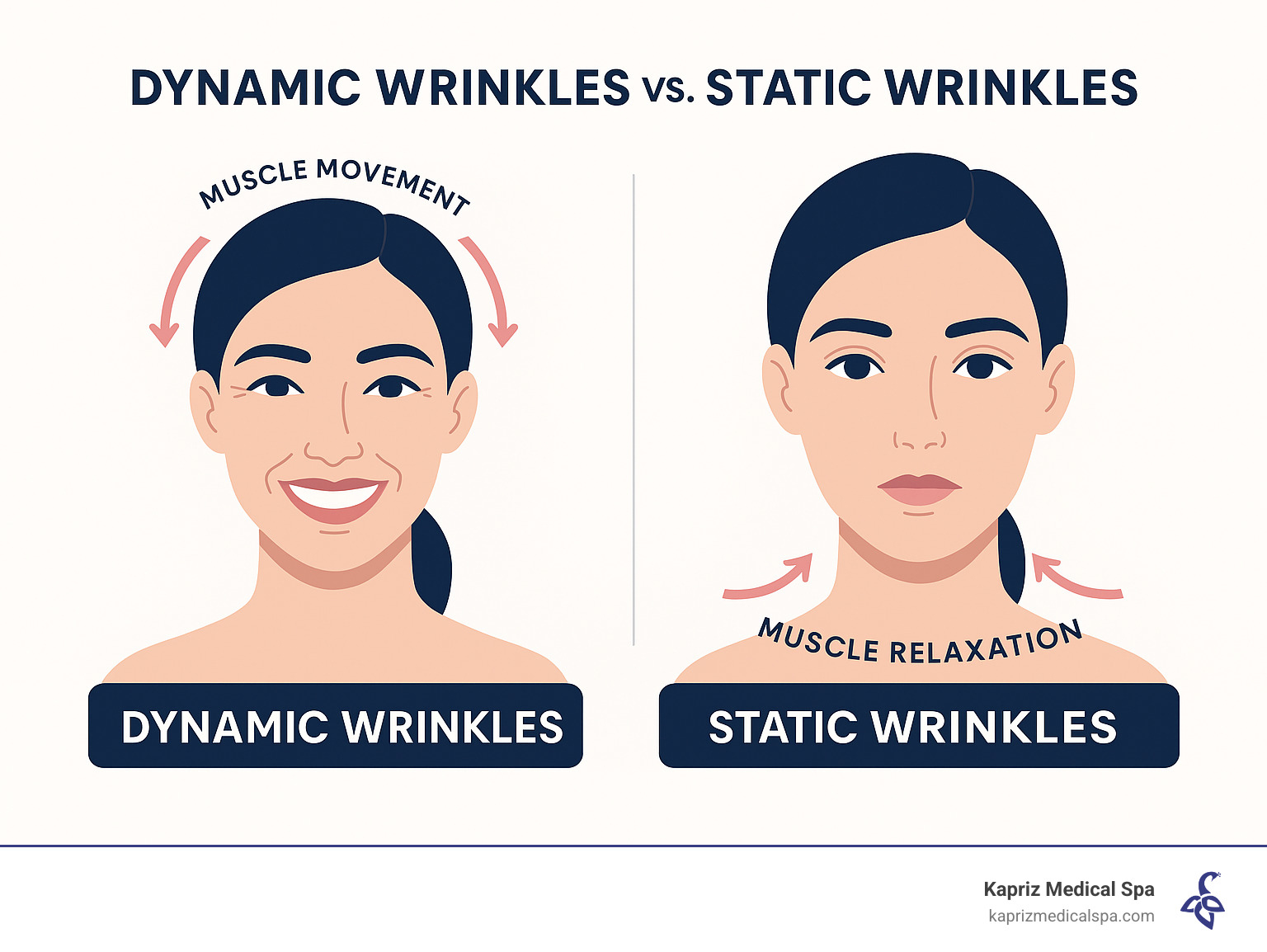 Infographic showing the difference between dynamic wrinkles that appear during facial expressions and static wrinkles that remain visible at rest, with arrows indicating muscle movement and relaxation - how many botox units for smile lines infographic Infographic showing the difference between dynamic wrinkles that appear during facial expressions and static wrinkles that remain visible at rest, with arrows indicating muscle movement and relaxation - how many botox units for smile lines infographic